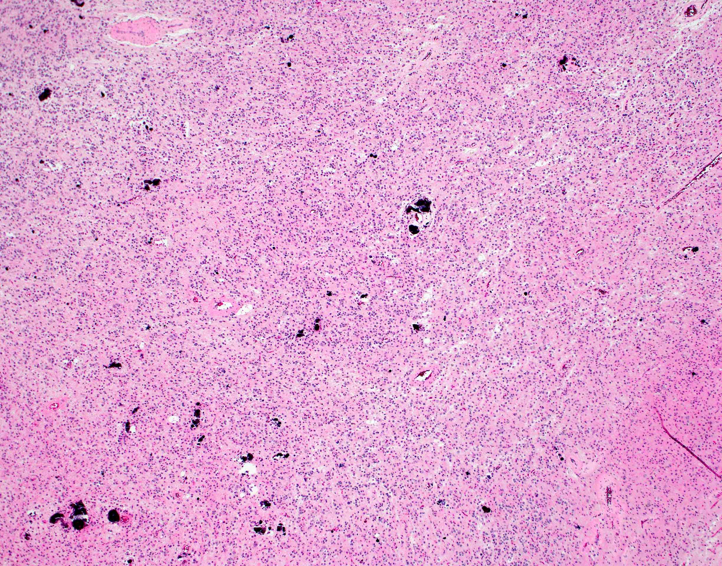 Diffusely infiltrating glial neoplasm