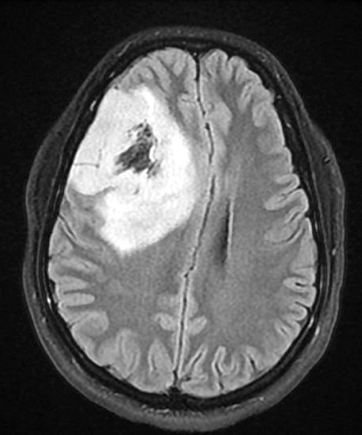 MRI: frontal lobe tumor with cystic change