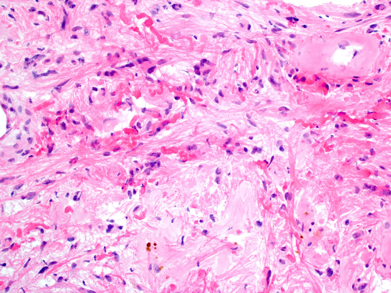 Atypical piloid glial cells