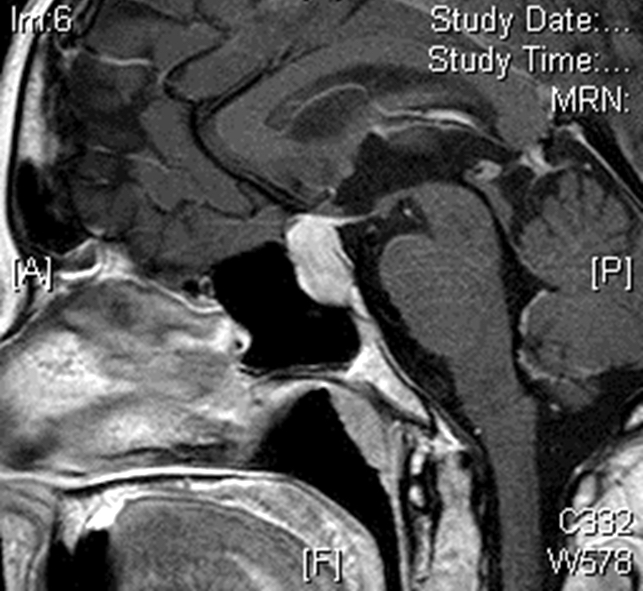 Sagittal postcontrast MRI