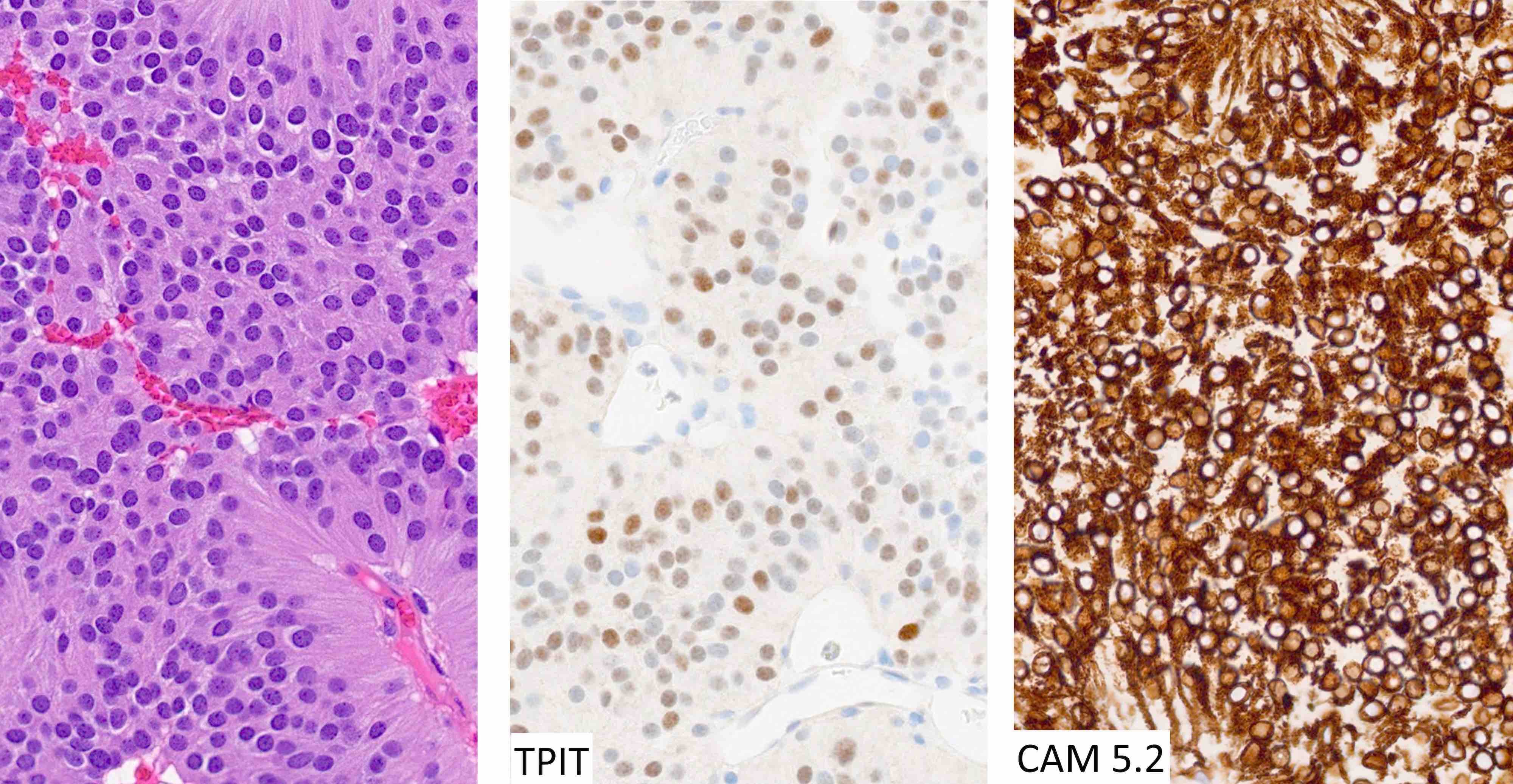 Sparsely granulated corticotroph tumor