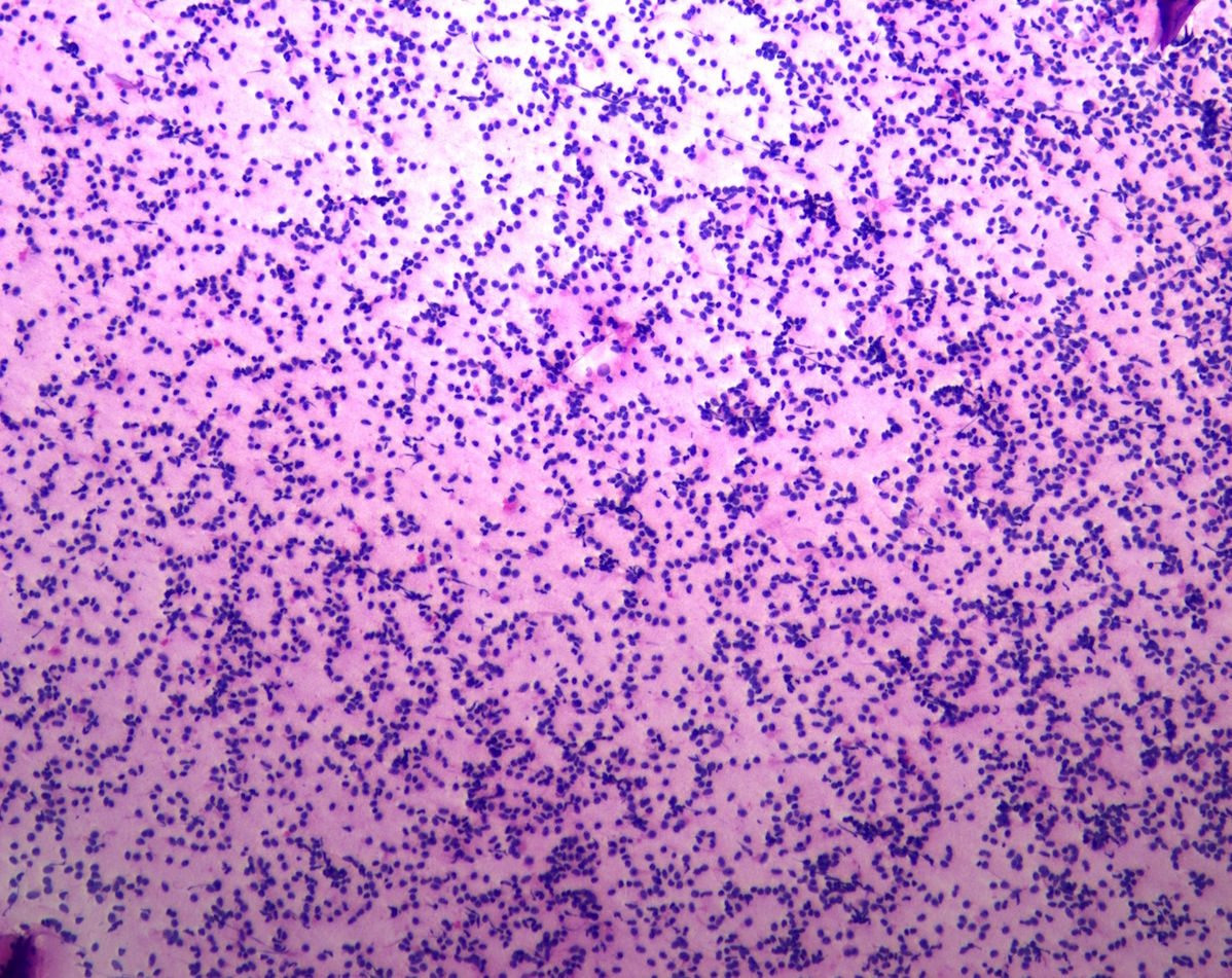 Touch prep showing a cellular population of discohesive small round blue cells