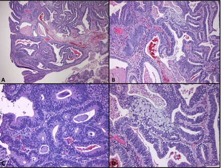Colorectal cancer histopathology. Rectal cancer vascular invasion.