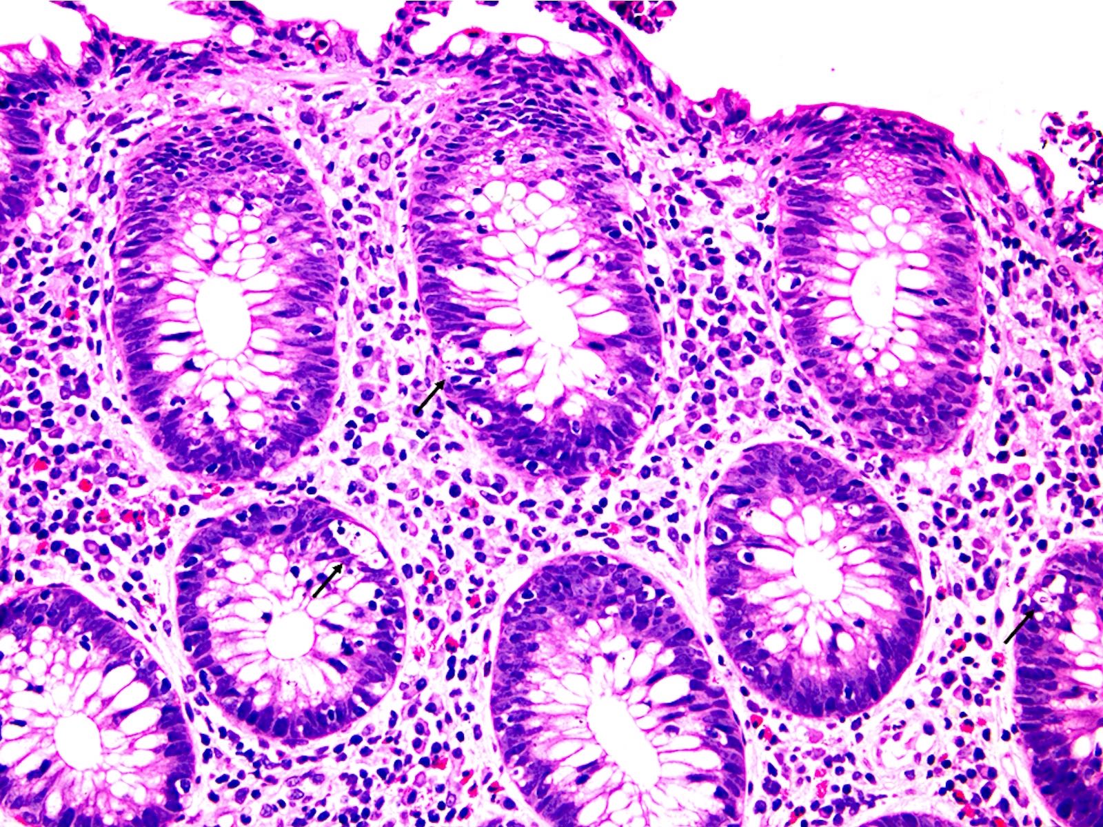 Prominent crypt epithelial cell apoptosis