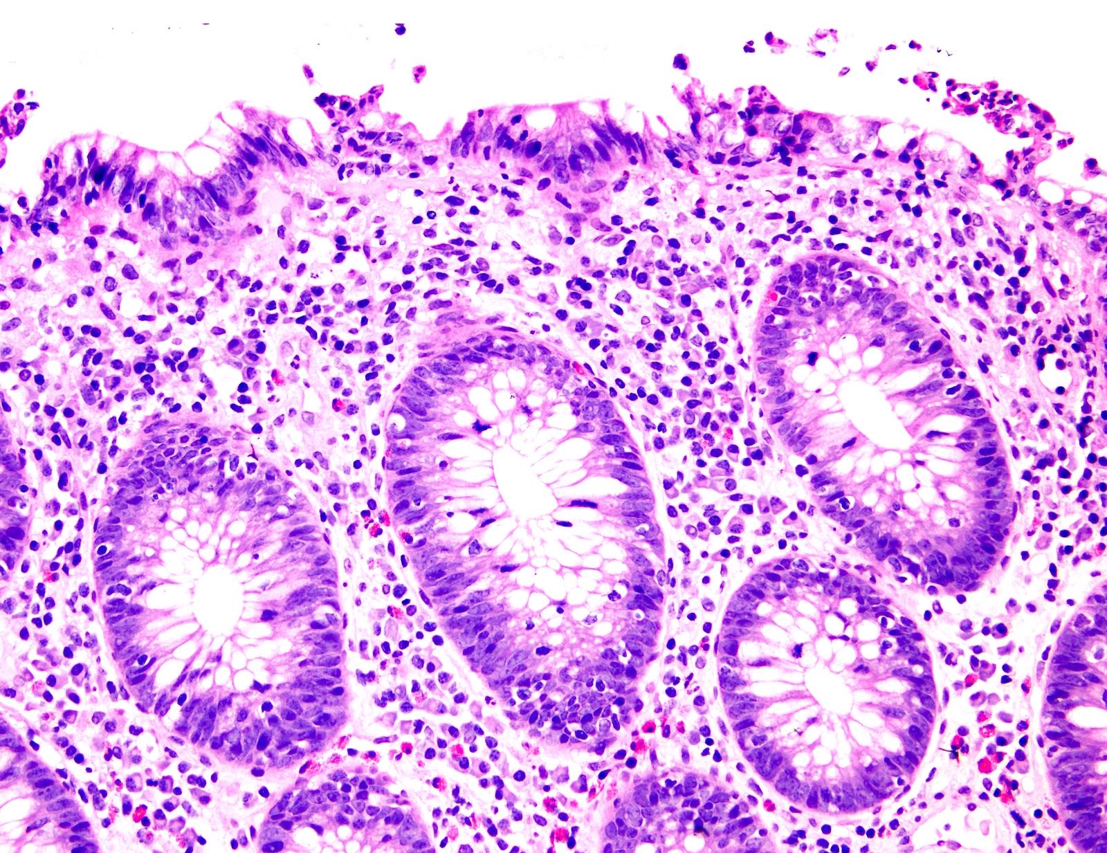 Lymphocytic colitis-like pattern