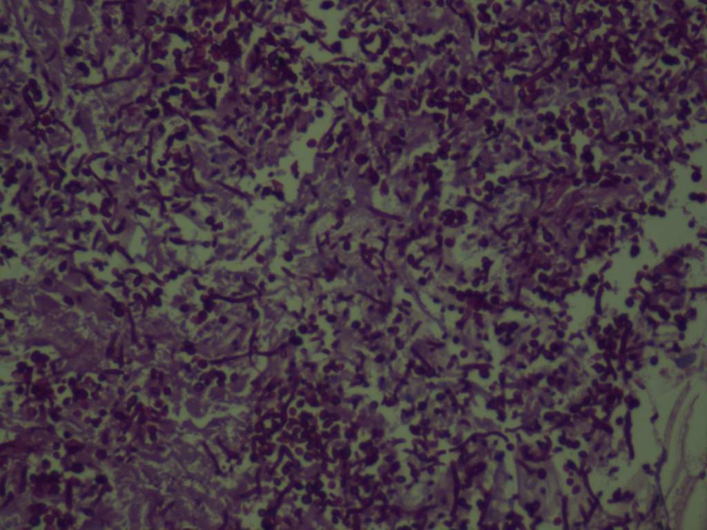 Pathology Outlines - Candida