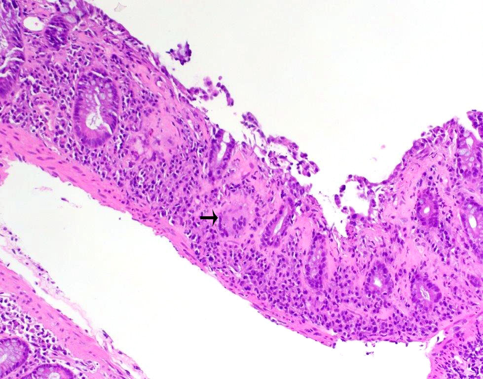 Collagenous Colitis Pathology Outlines