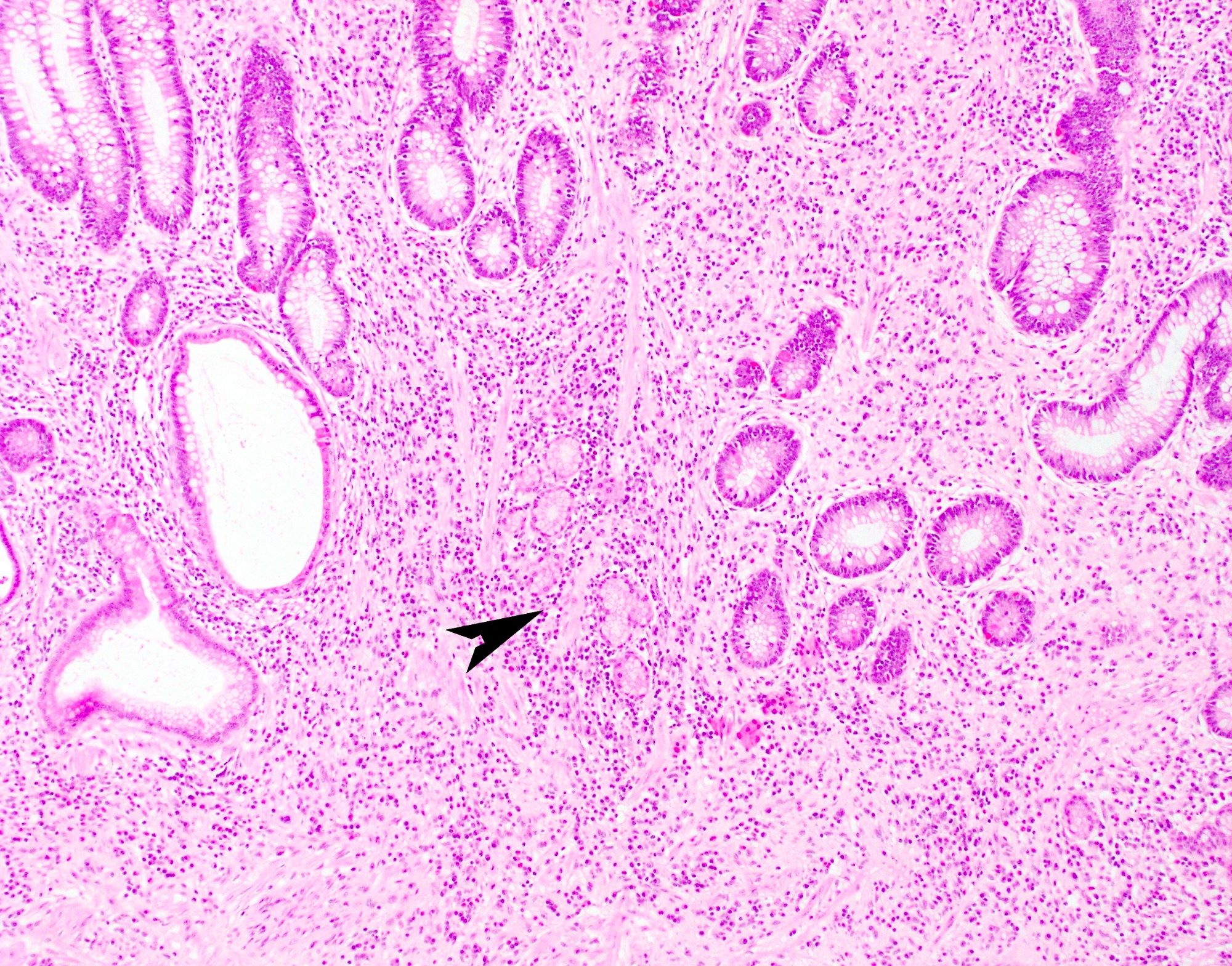 Pyloric gland metaplasia