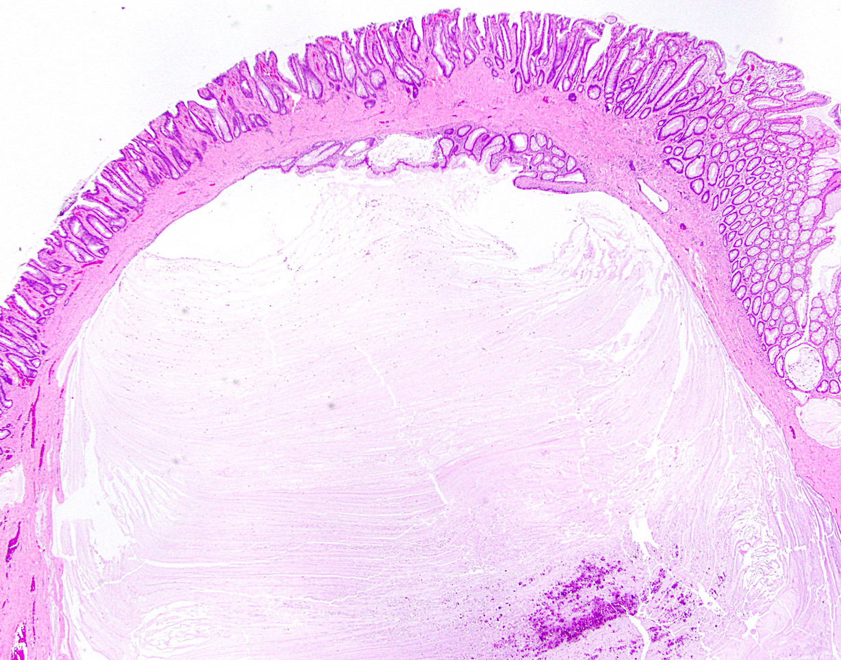 Pathology Outlines Colitis cystica profunda