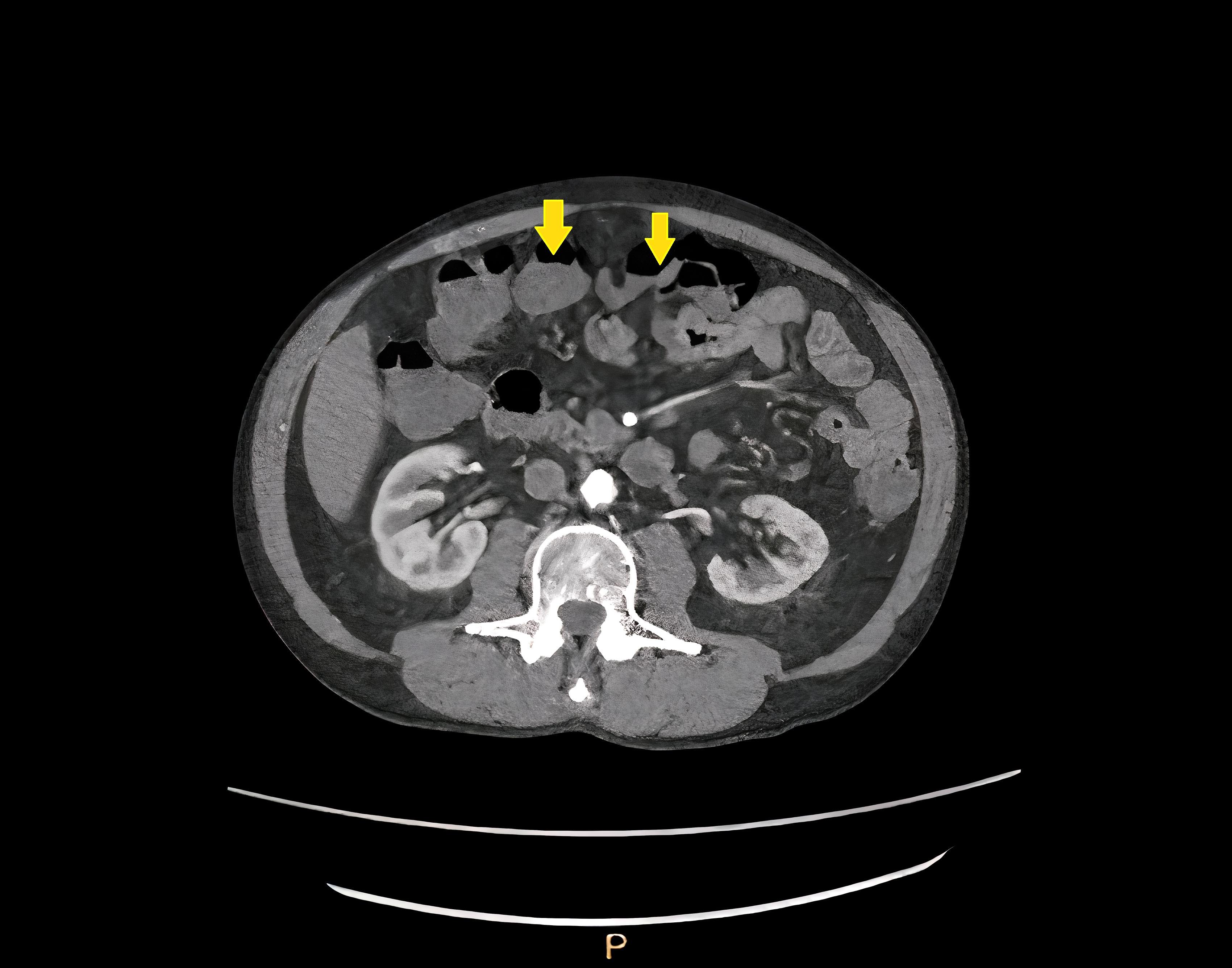 CT of abdomen and pelvis