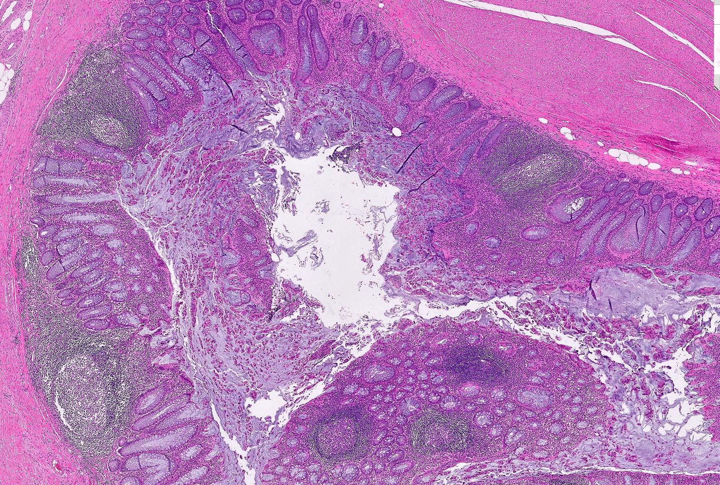Lymphoid aggregates in diverticular wall