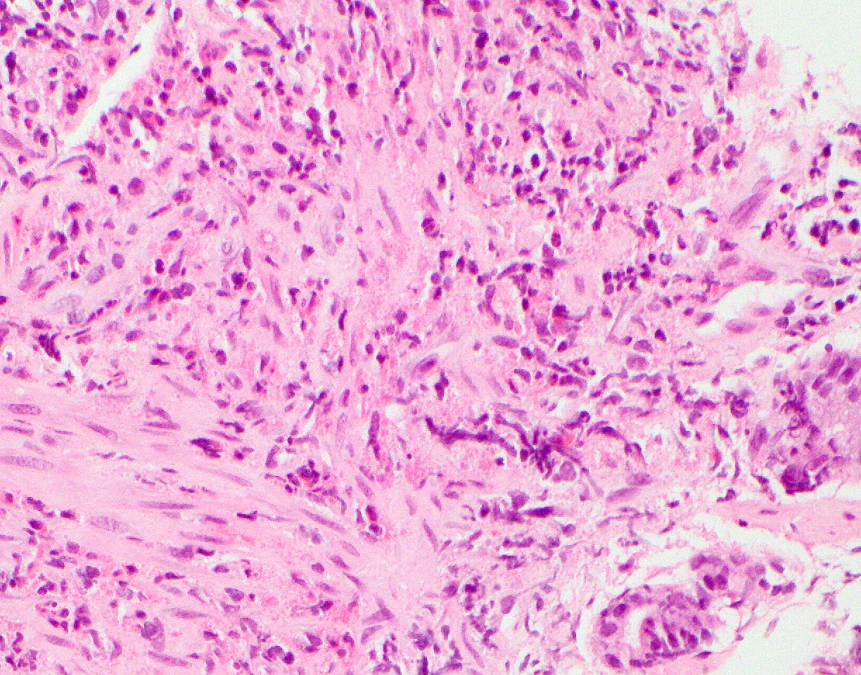 Eosinophils in muscularis mucosae
