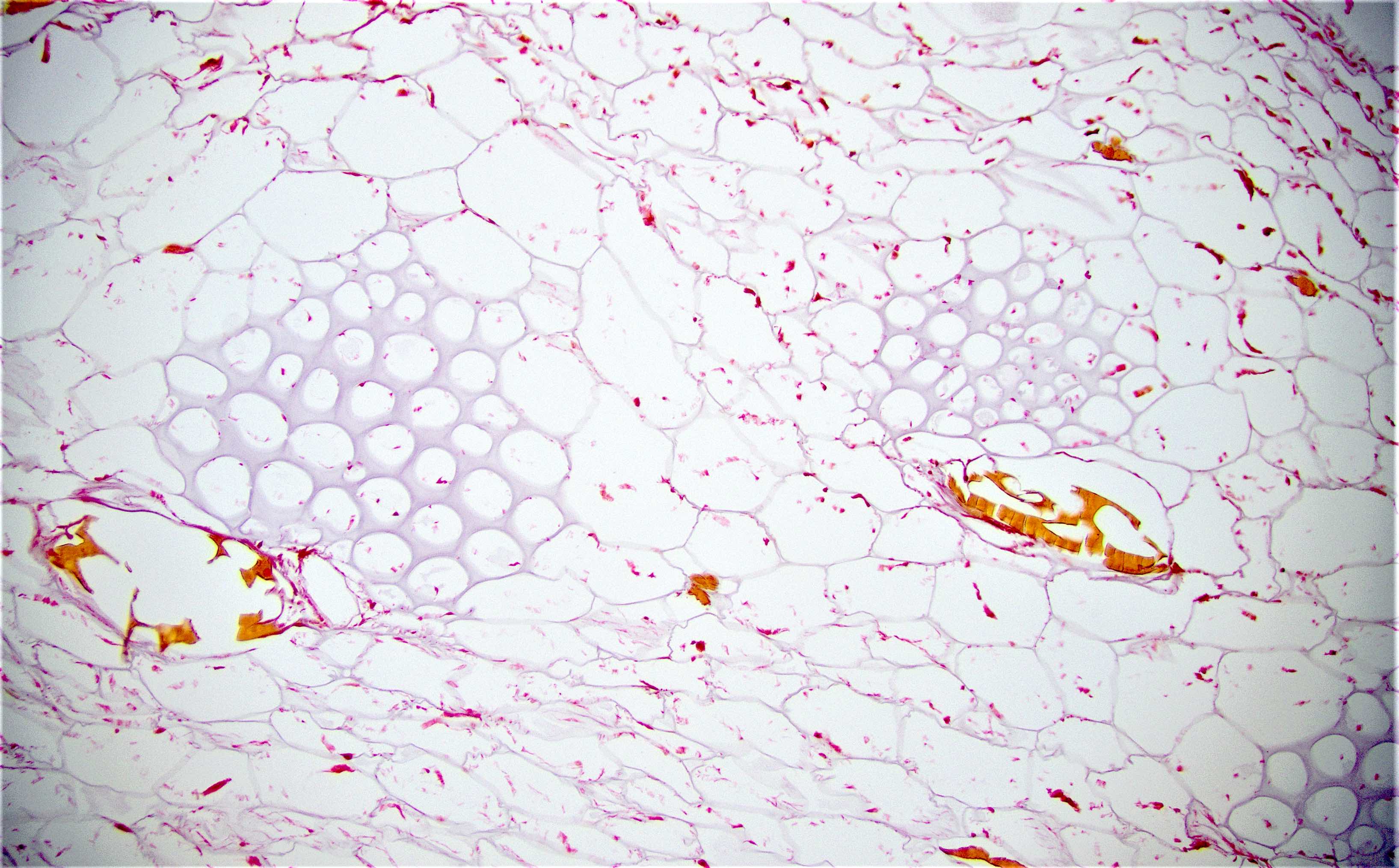 Pathology Outlines - Foreign materials / food