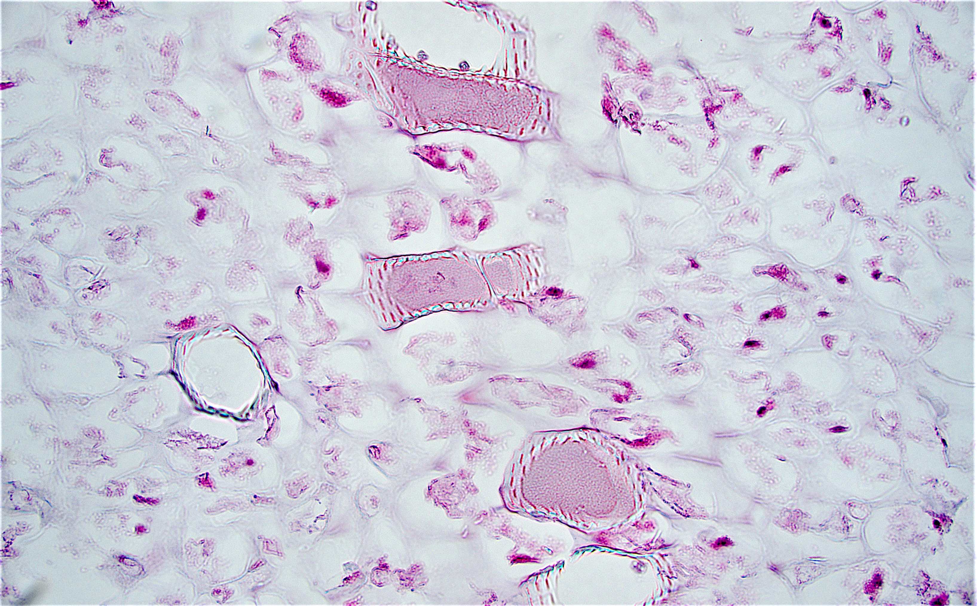Pathology Outlines - Foreign materials / food