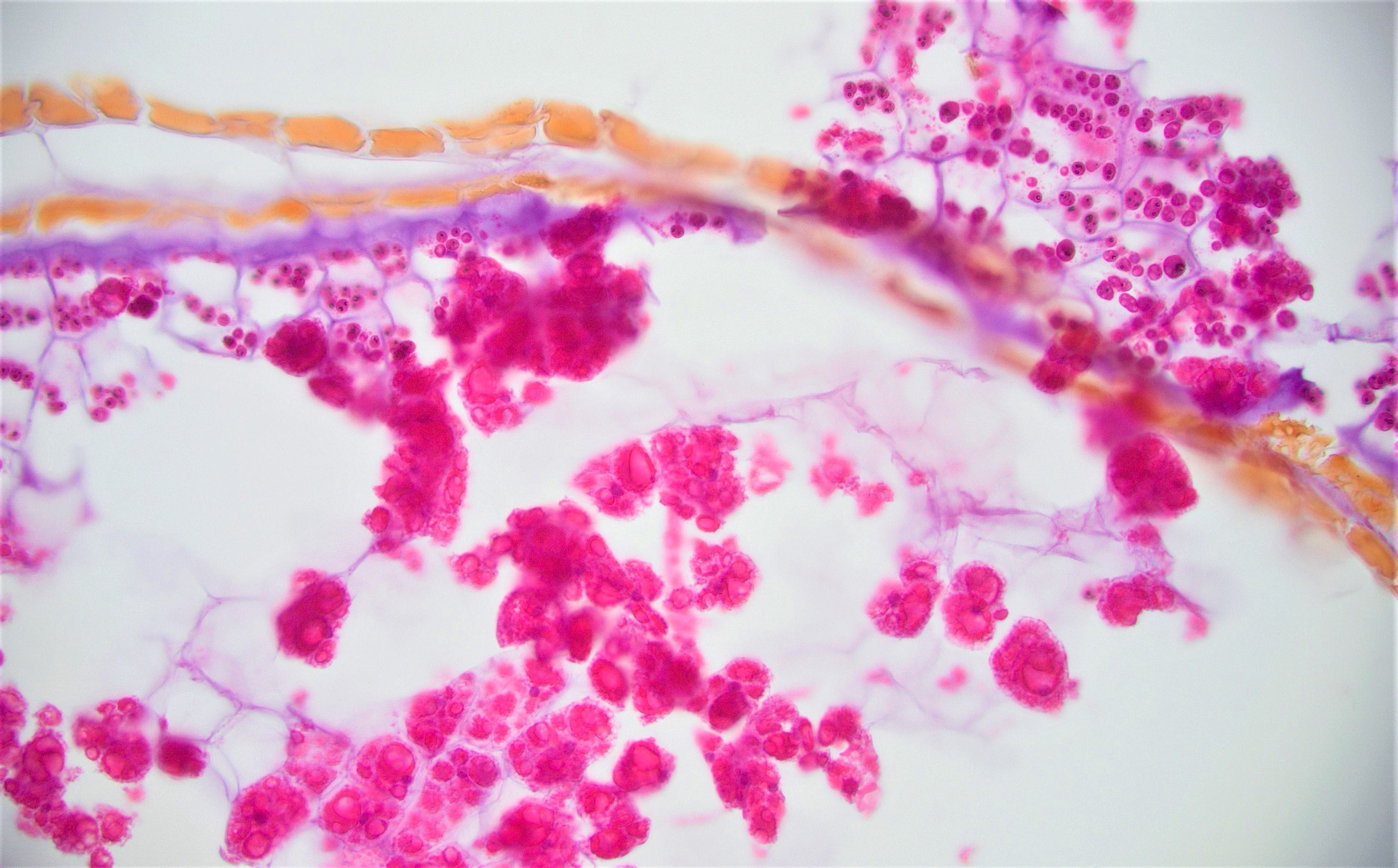 Pathology Outlines - Foreign materials / food