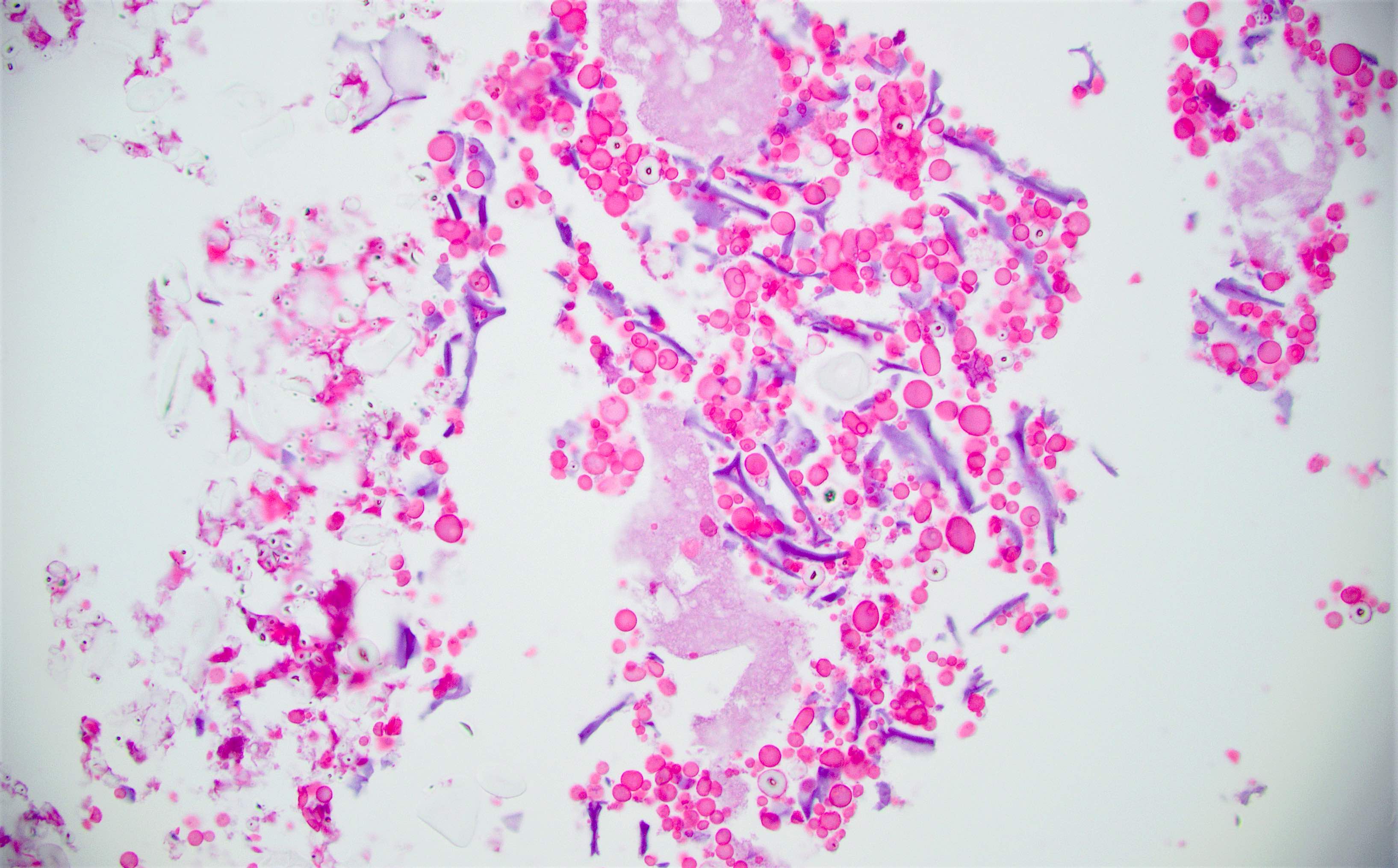 Pathology Outlines - Foreign materials / food