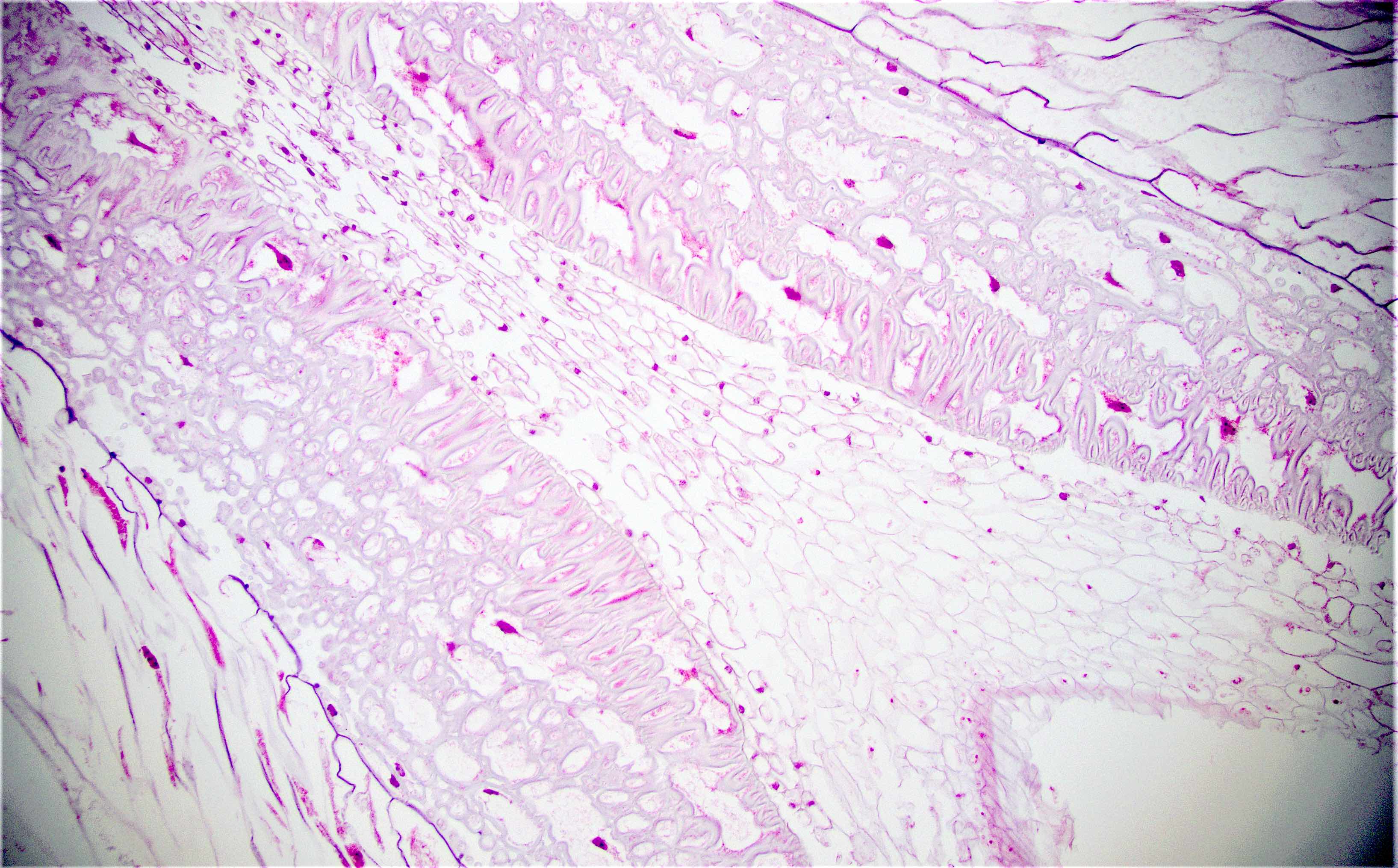 Pathology Outlines - Foreign materials / food