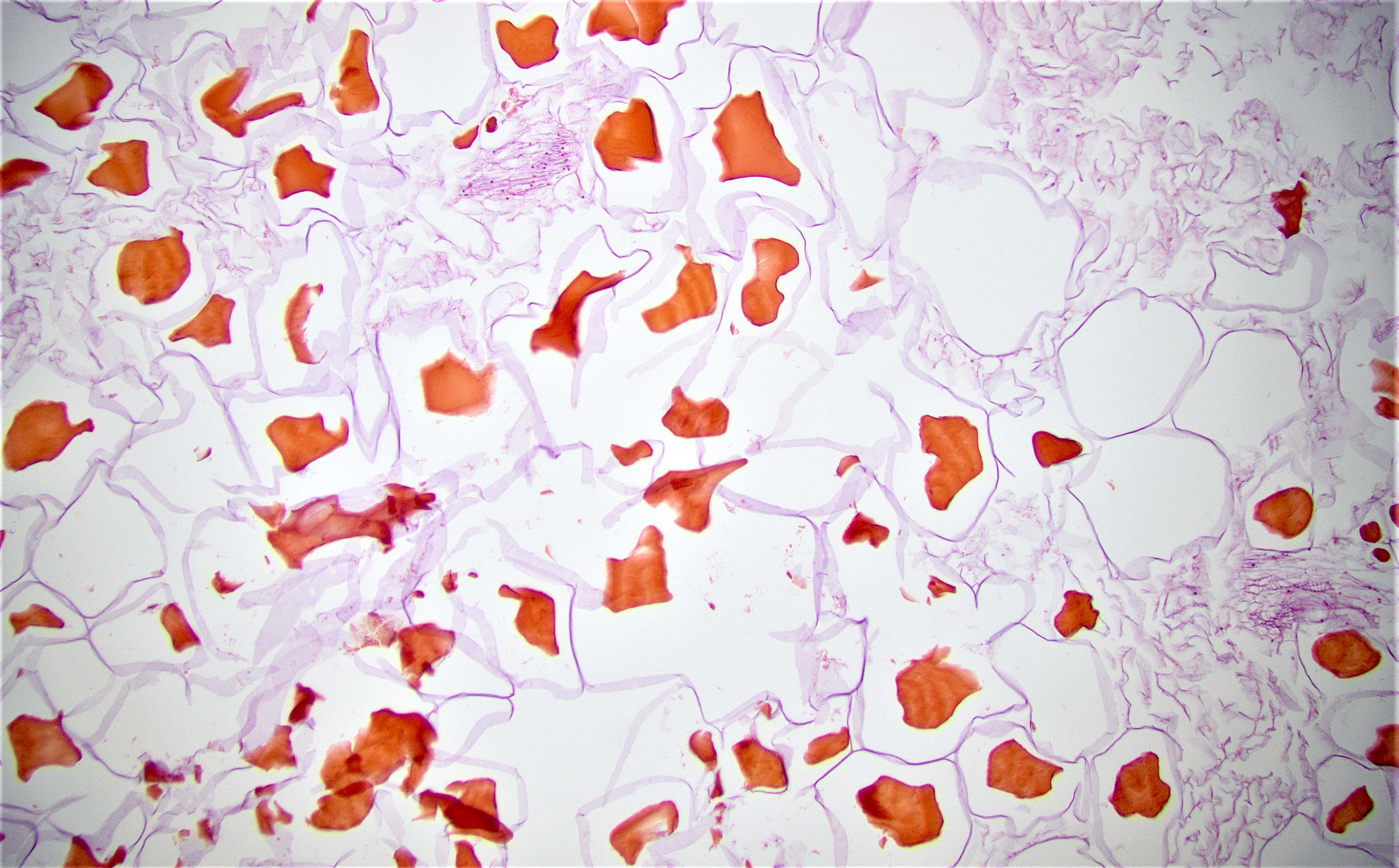 Pathology Outlines - Foreign materials / food
