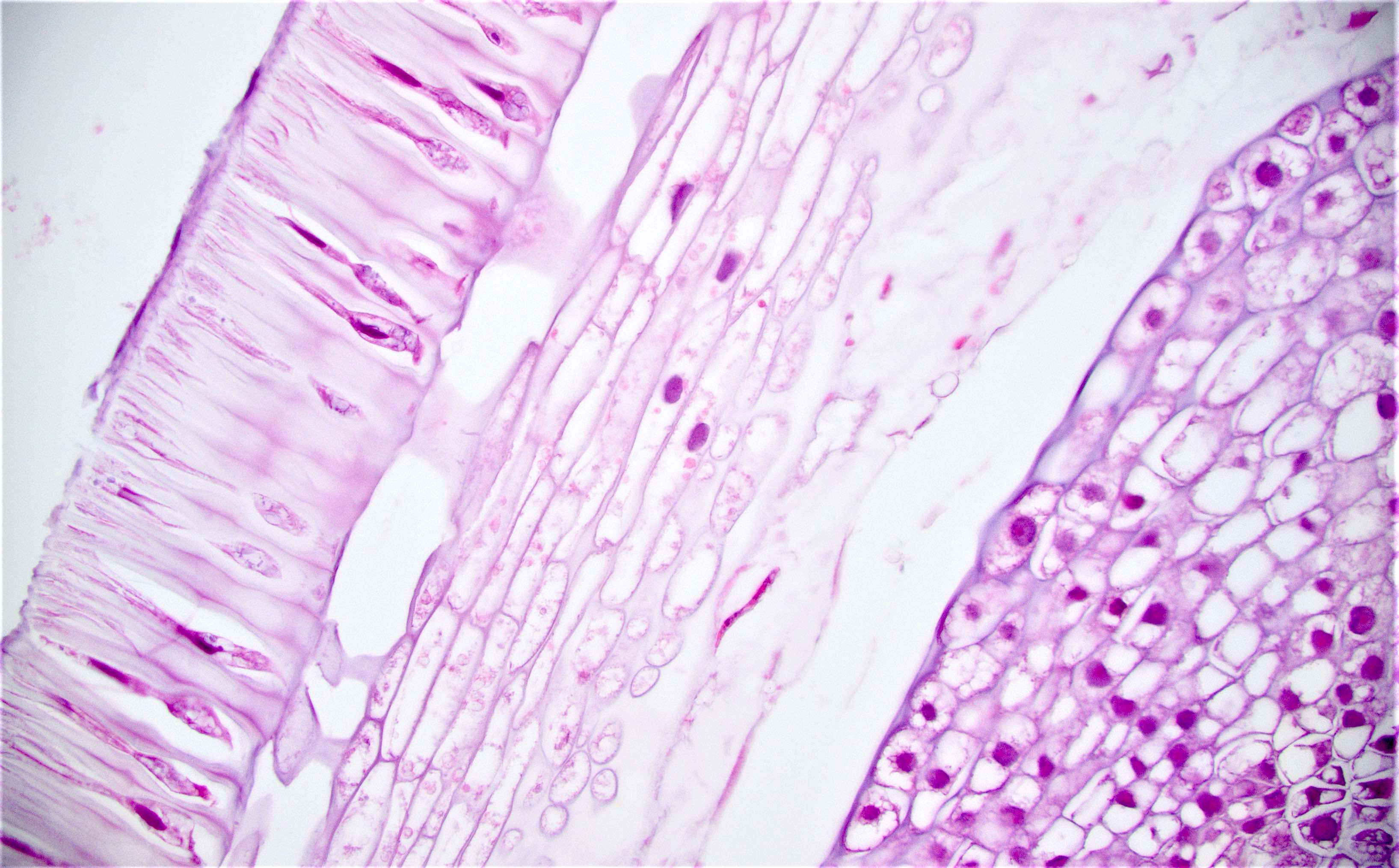 Pathology Outlines - Foreign materials / food