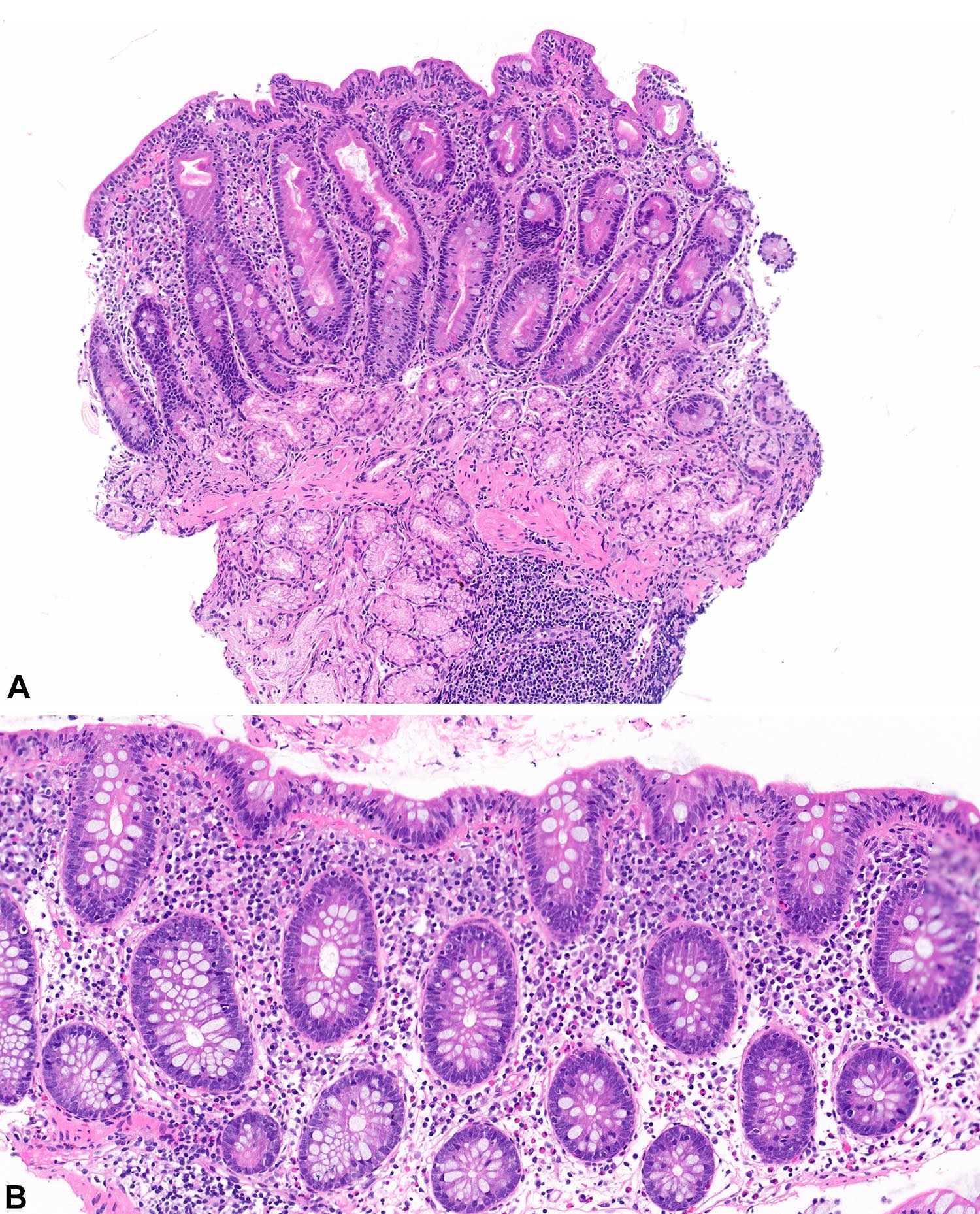 Collagenous Colitis Pathology Outlines
