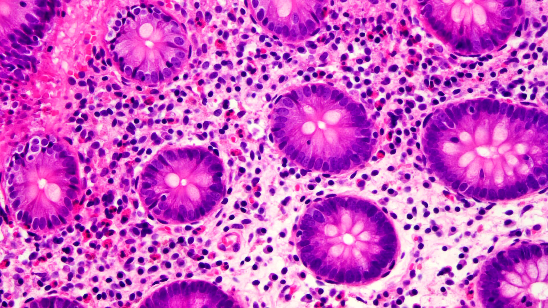Eosinophils in the infiltrate