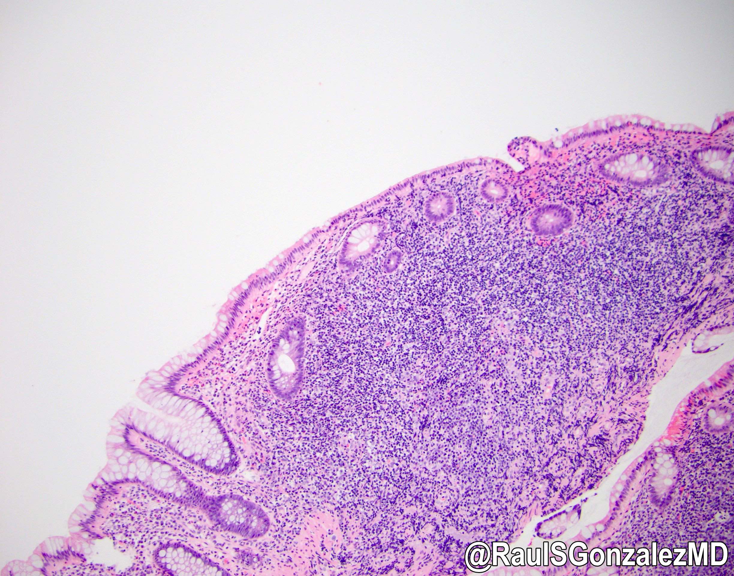 Intestinal spirochetosis