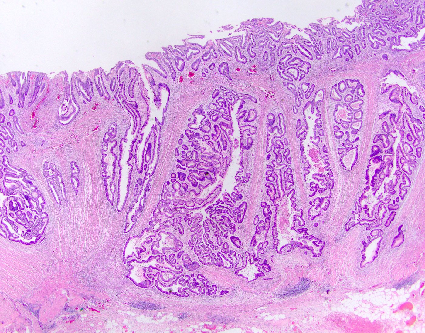 Ductal adenocarcinoma prostate pathology outlines