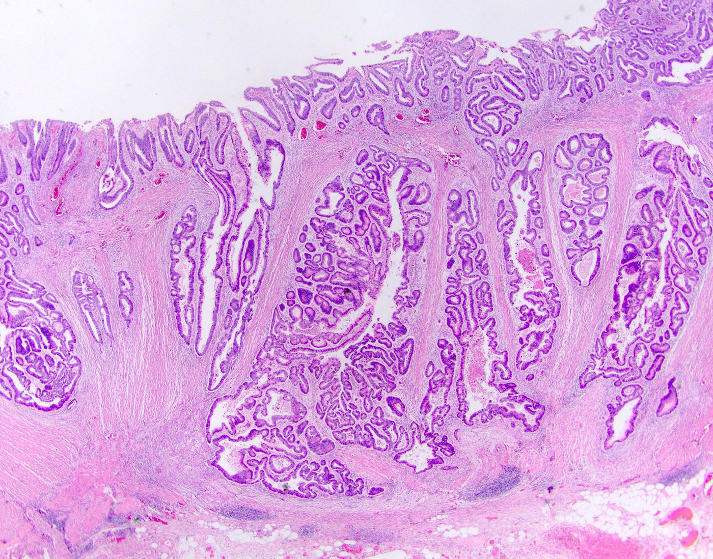 colon cancer stage pathology outlines)