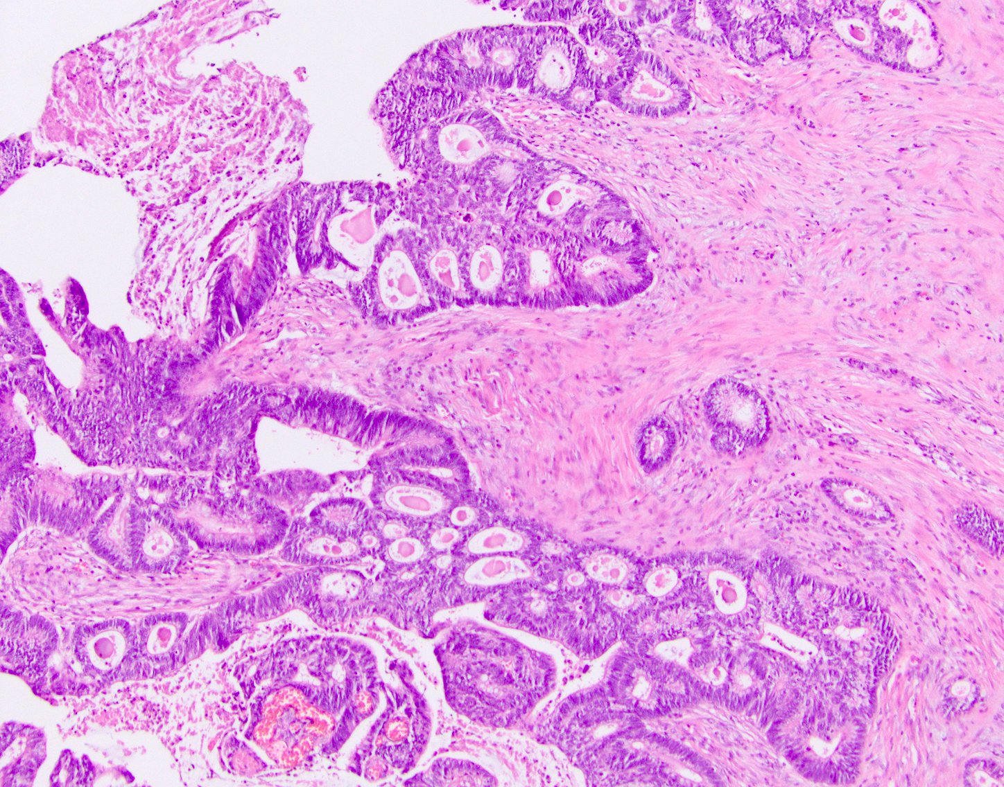 Adenocarcinoma Colon Histology