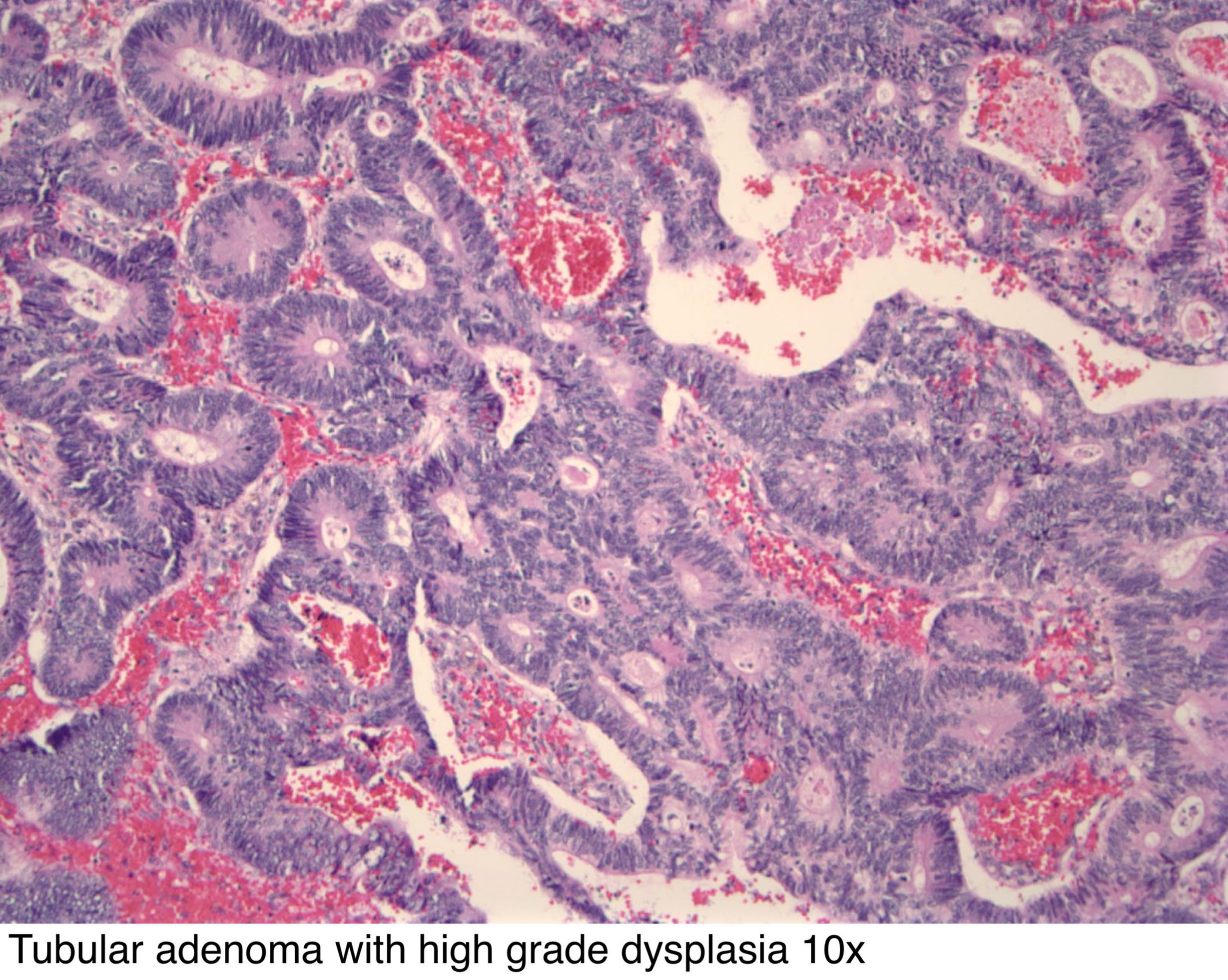 papilláris adenoma patológia körvonalai)