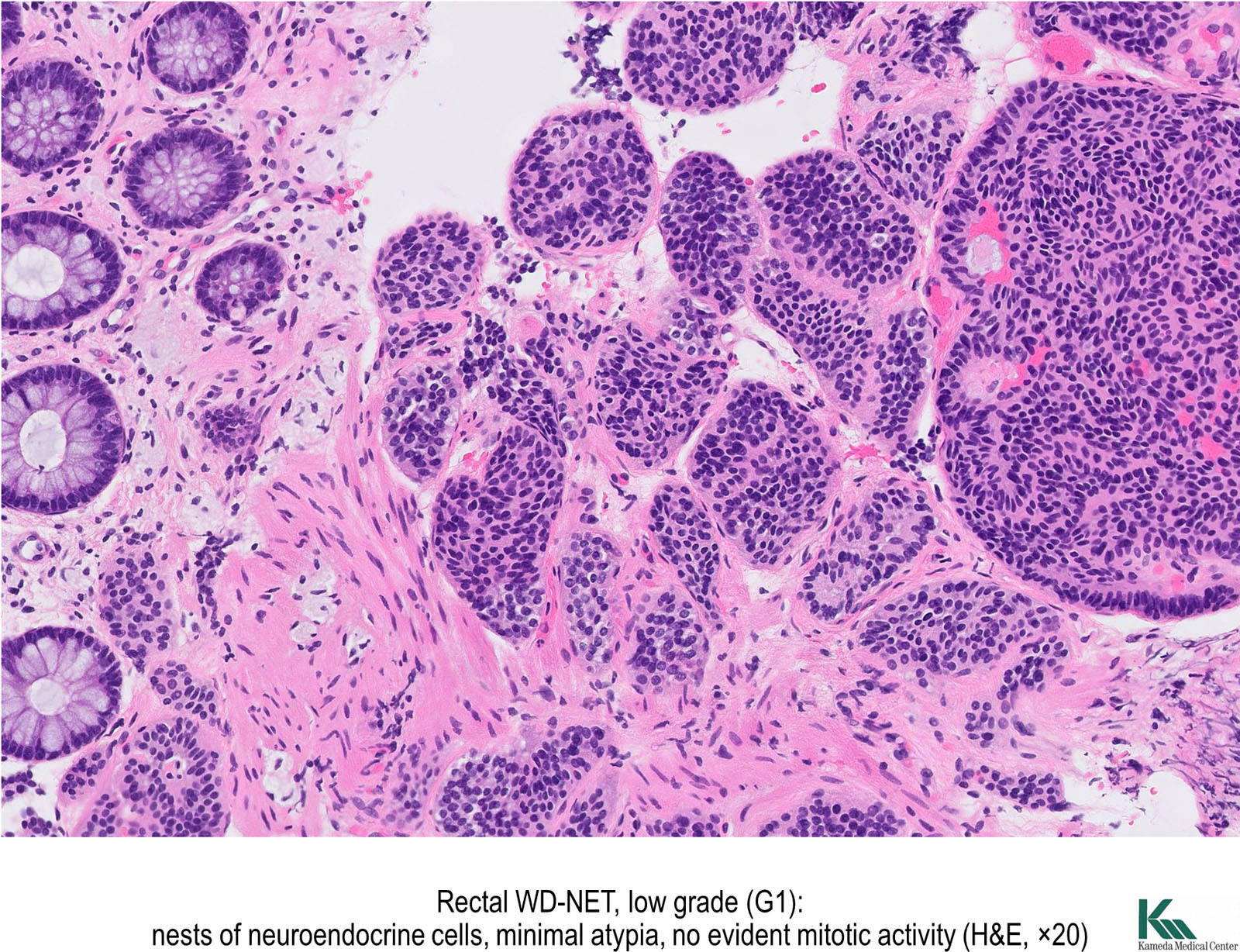 adenocarcinoma with neuroendocrine differentiation pathology outlines)