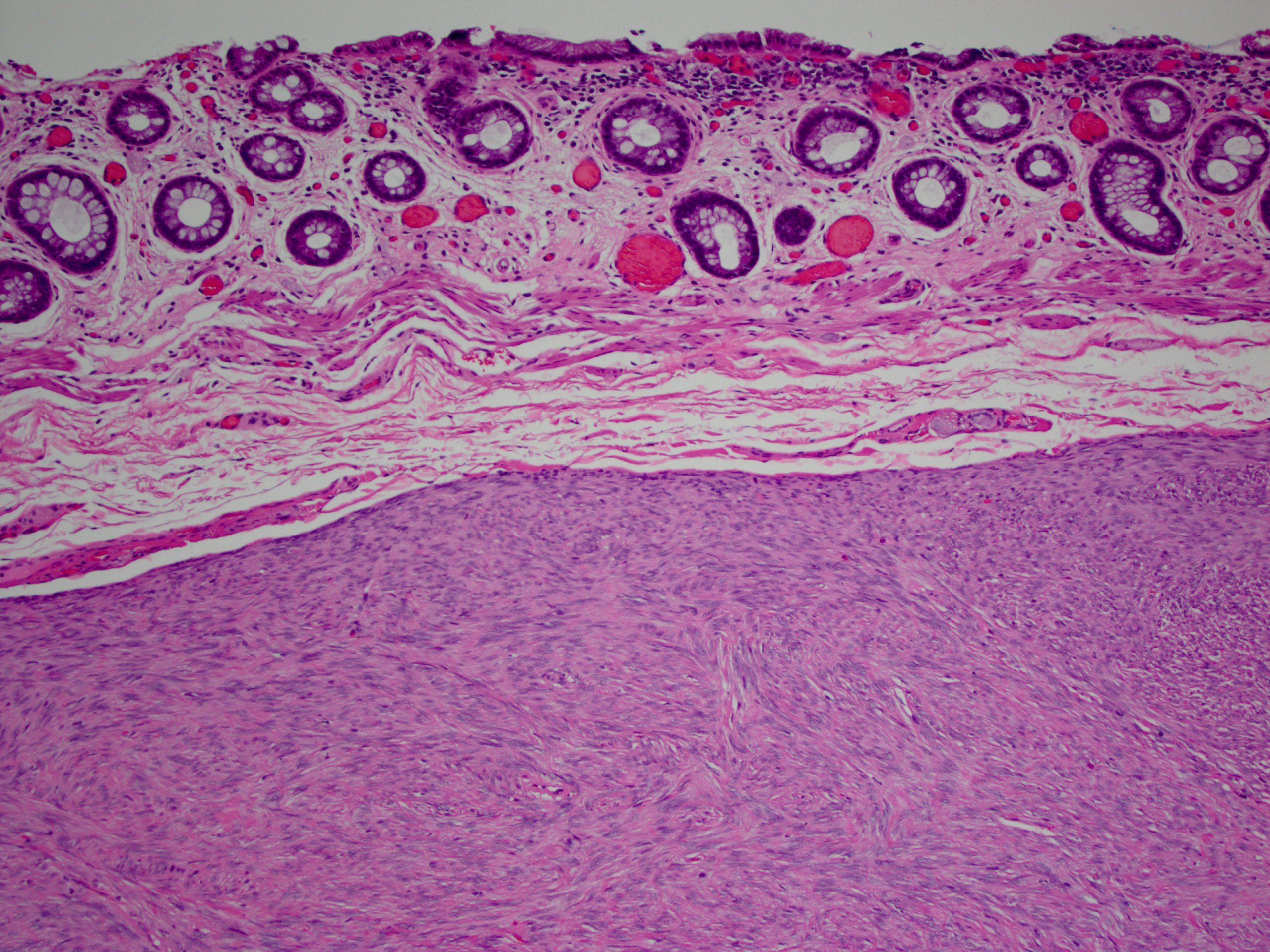 Pathology Outlines - Gastrointestinal stromal tumor.