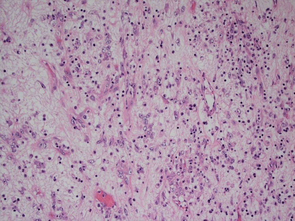 Inflammatory myofibroblastic tumor