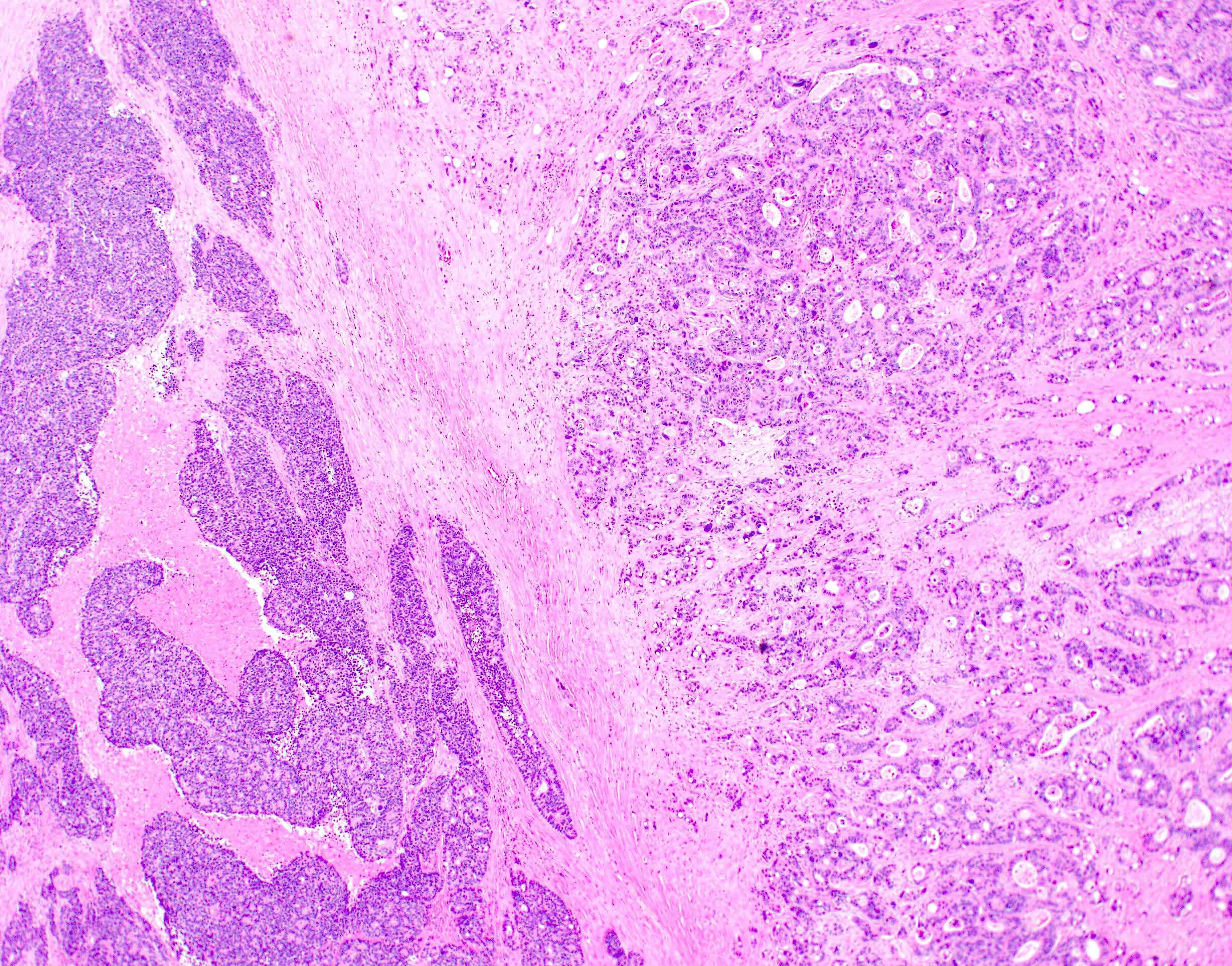 Mixed adenocarcinoma neuroendocrine carcinoma