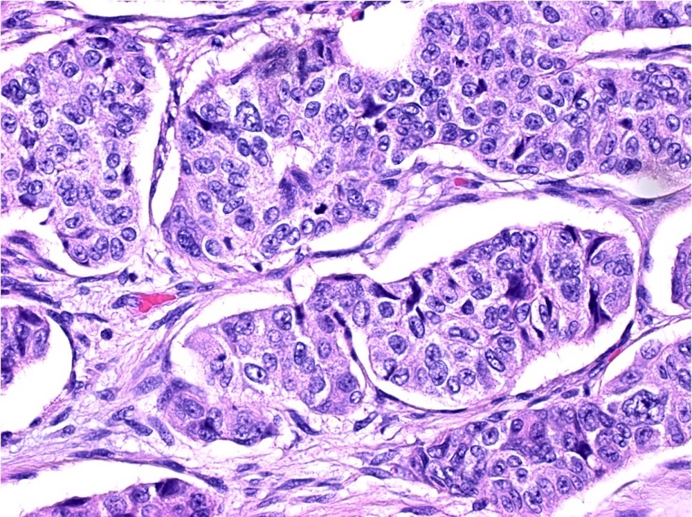 Acinar cell carcinoma component