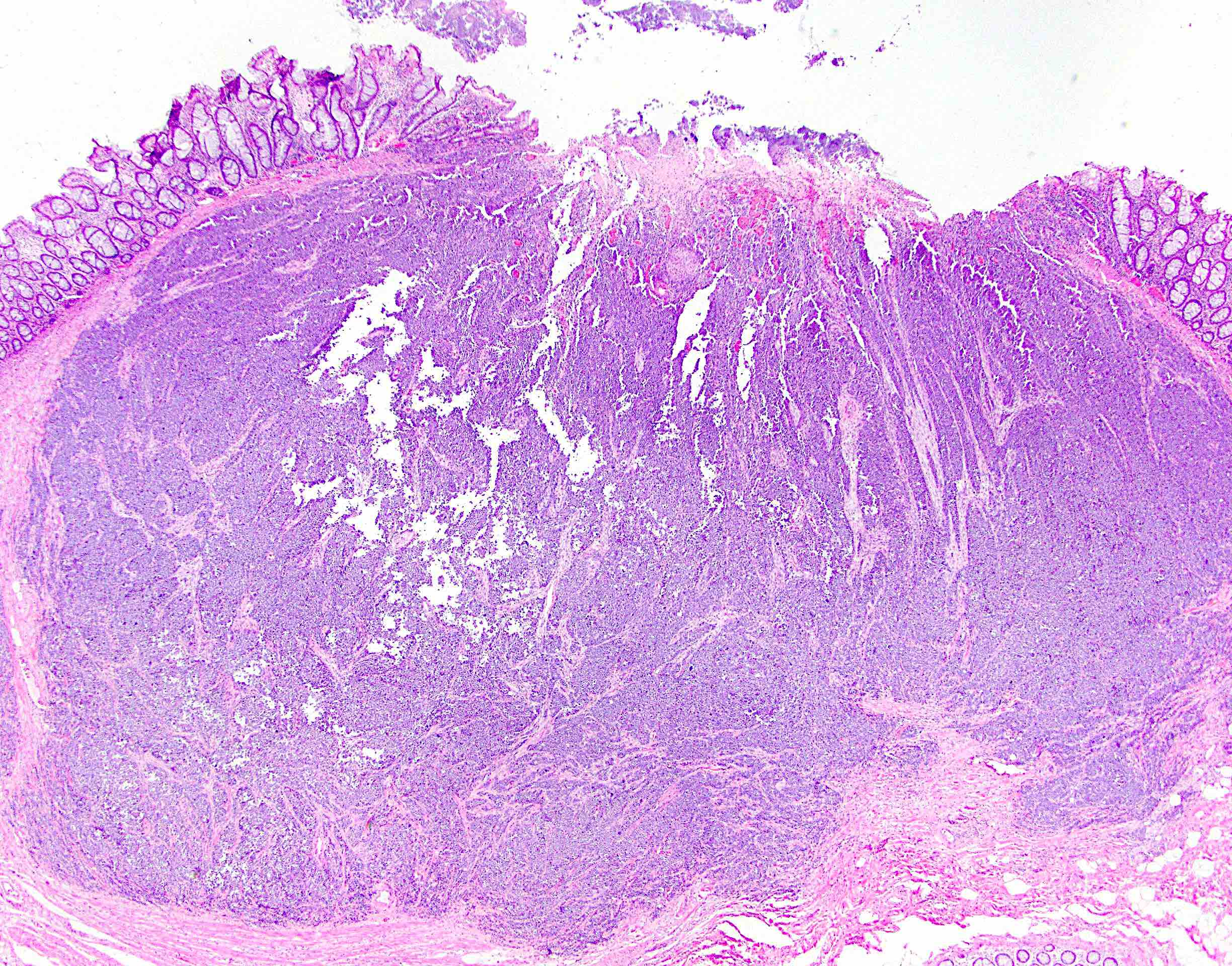 Large cell neuroendocrine carcinoma