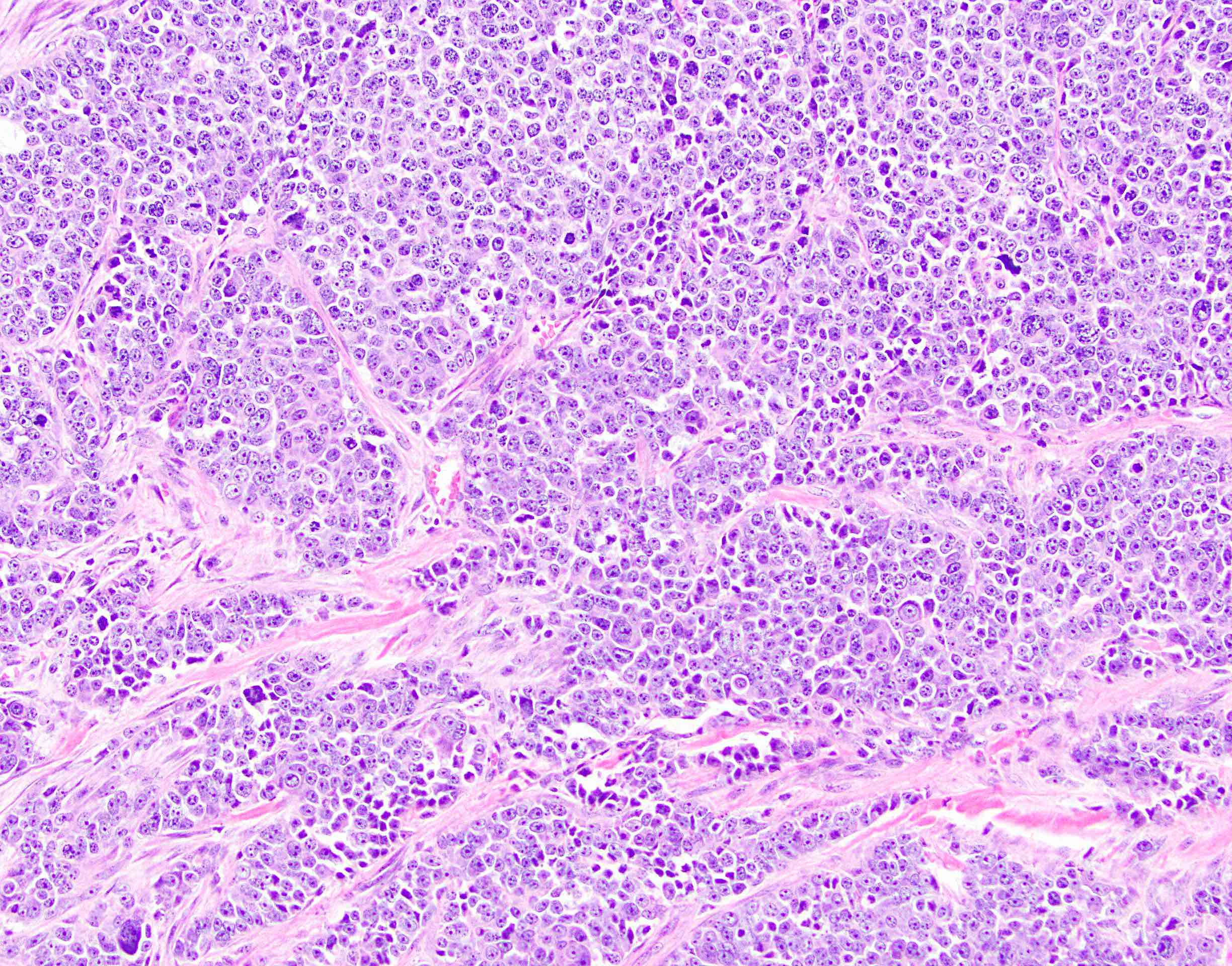 adenocarcinoma with neuroendocrine differentiation pathology outlines