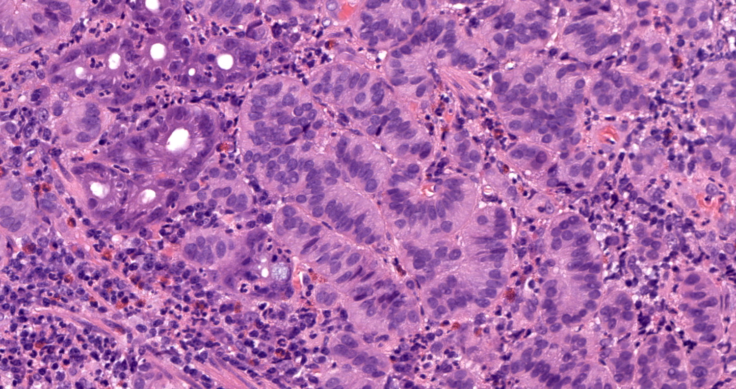 adenocarcinoma with neuroendocrine differentiation pathology outlines)