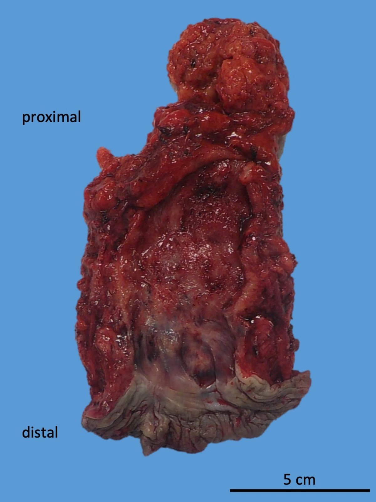 Ulcerative proctitis