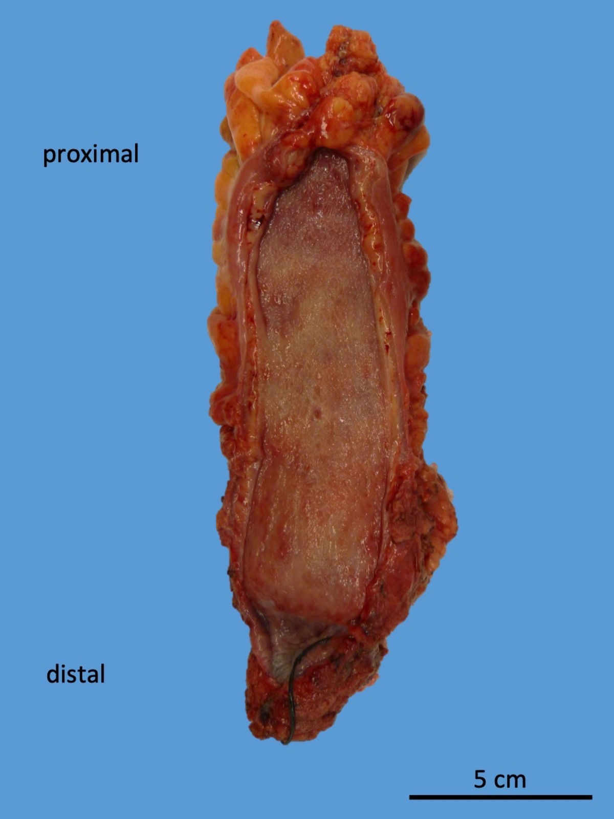 Ulcerative proctitis, atrophic