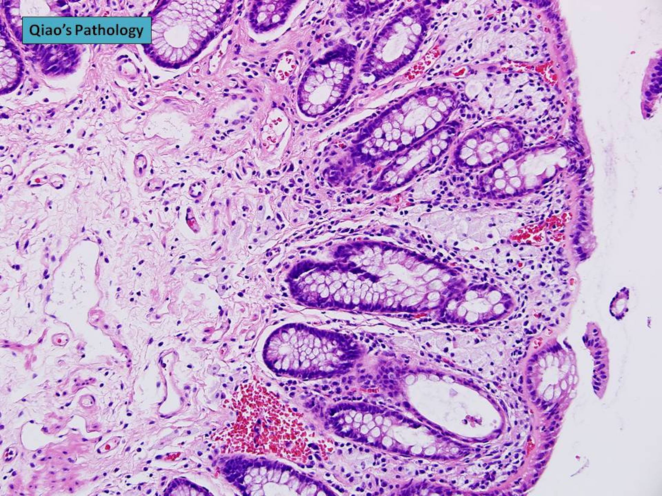Pathology Outlines Xanthoma