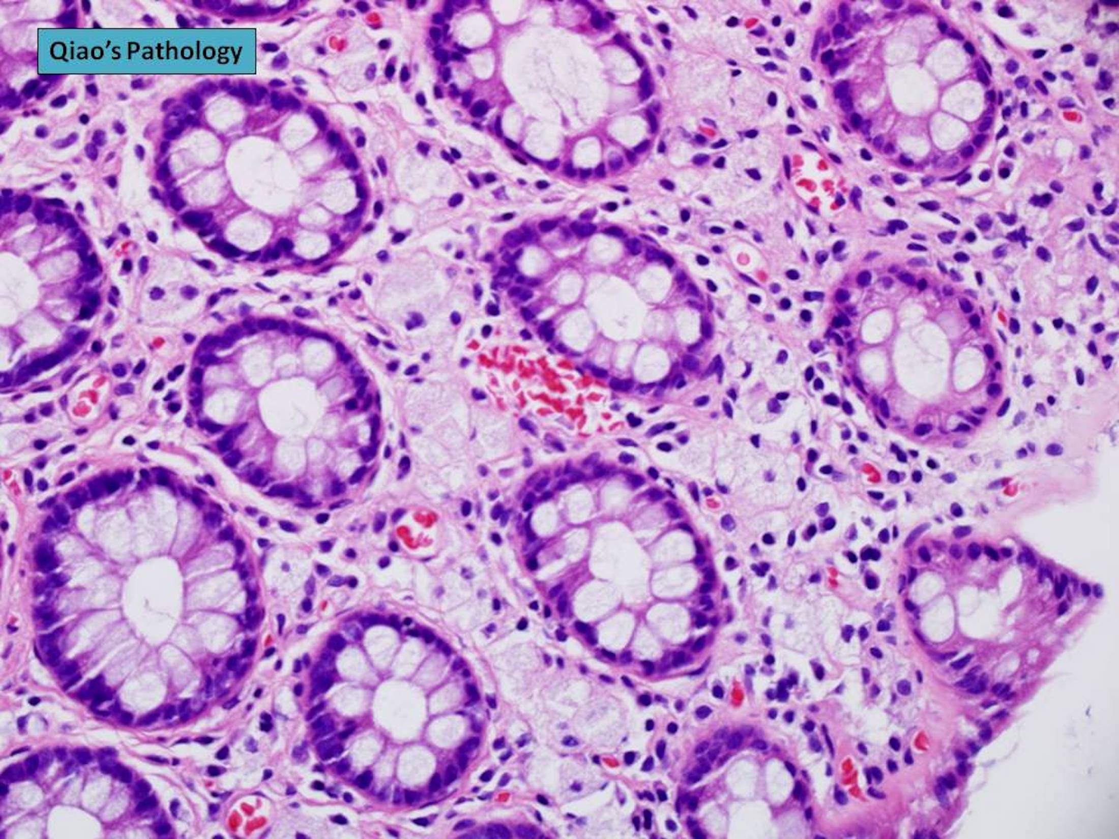 Pathology Outlines Xanthoma