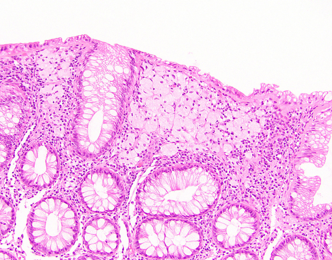 Pathology Outlines Xanthoma