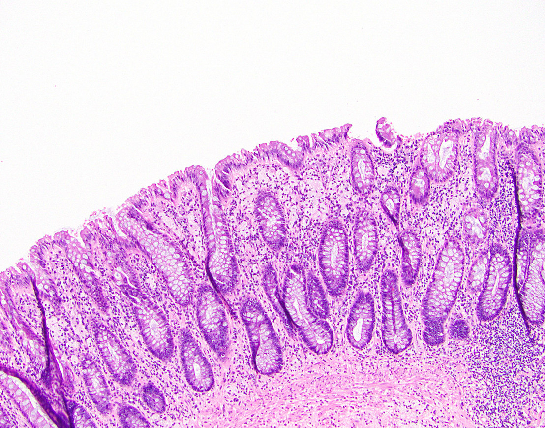 Pathology Outlines Xanthoma