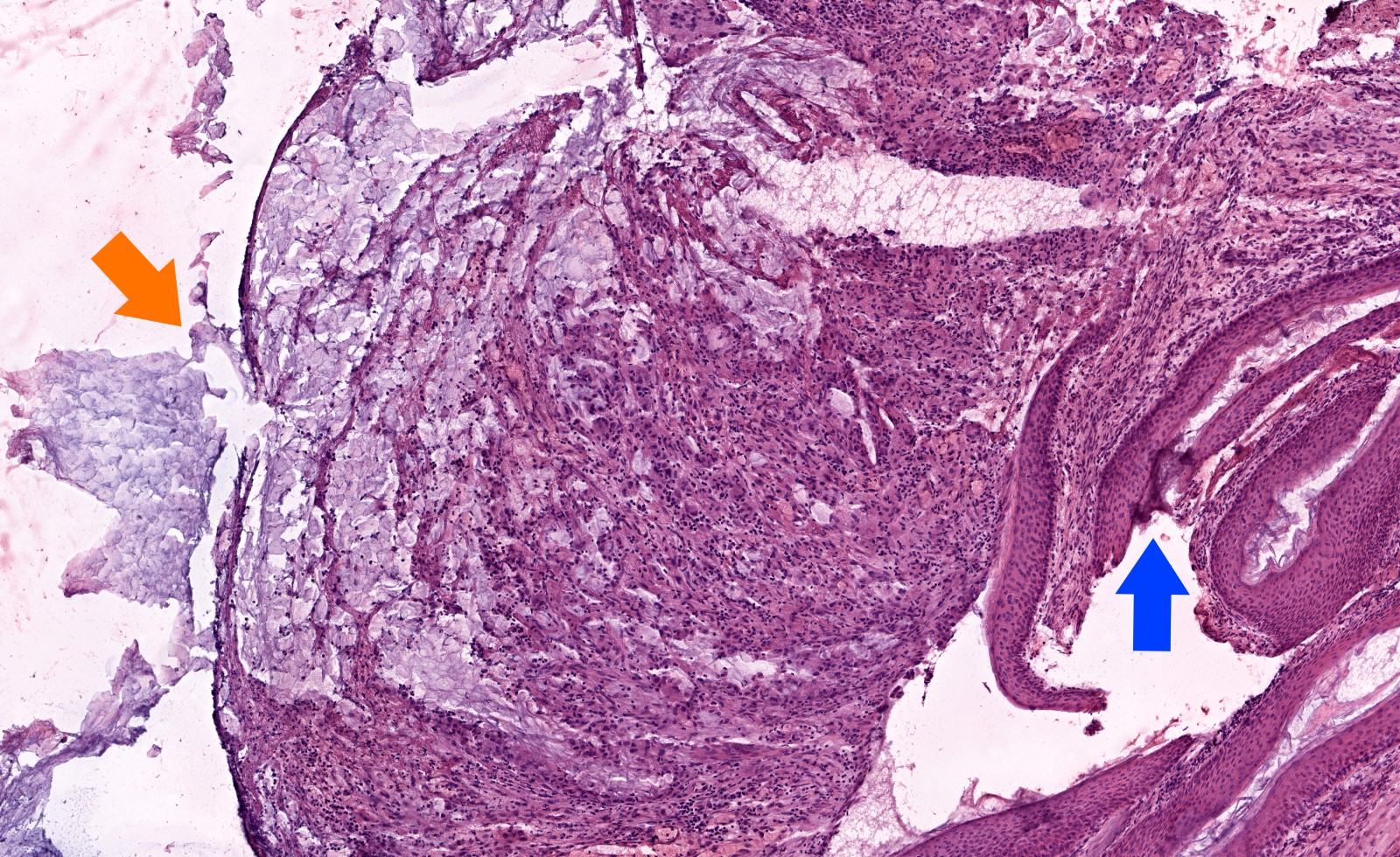 Cholesteatoma, frozen section appearance