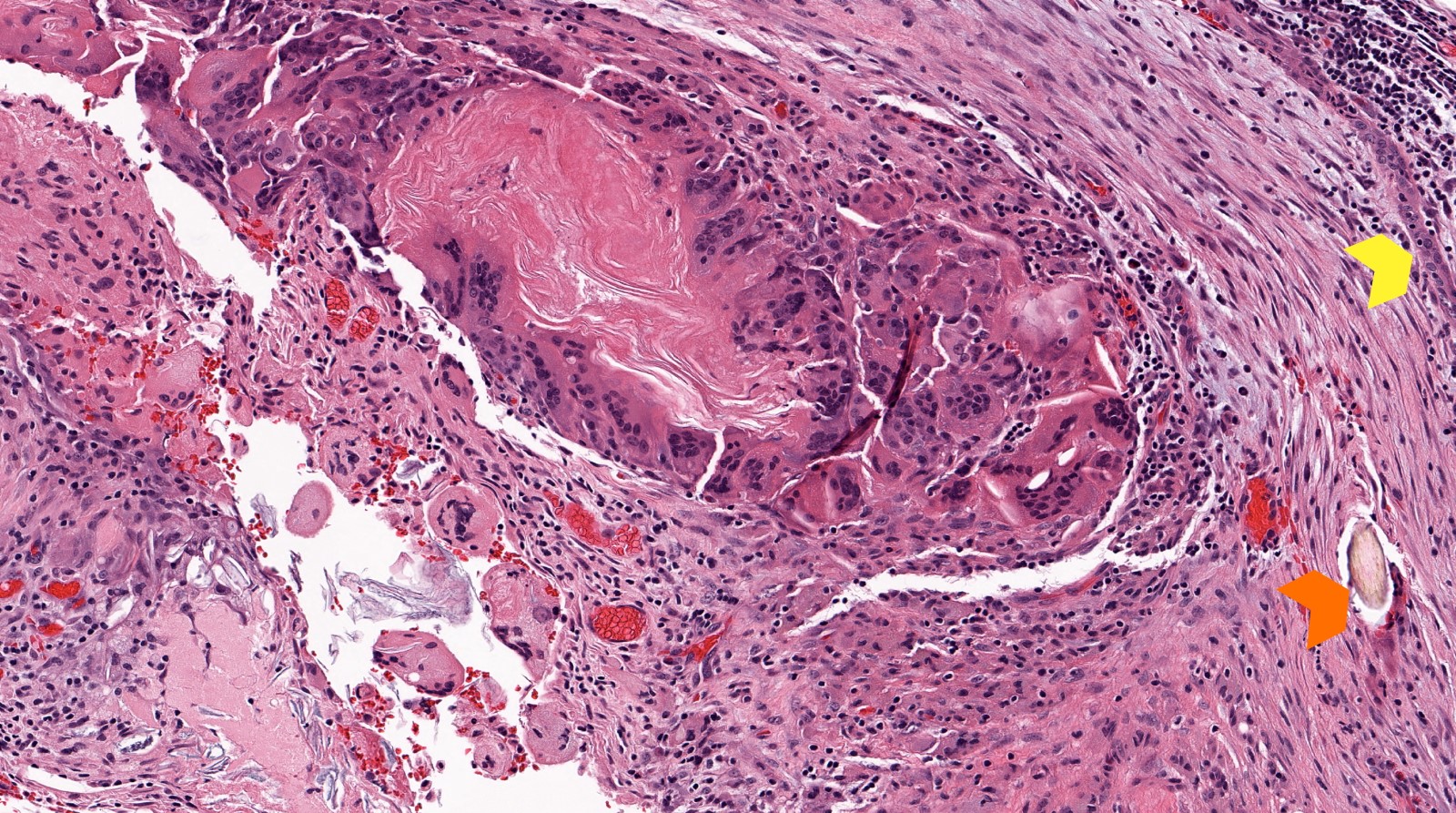 Cholesteatoma, inflamed