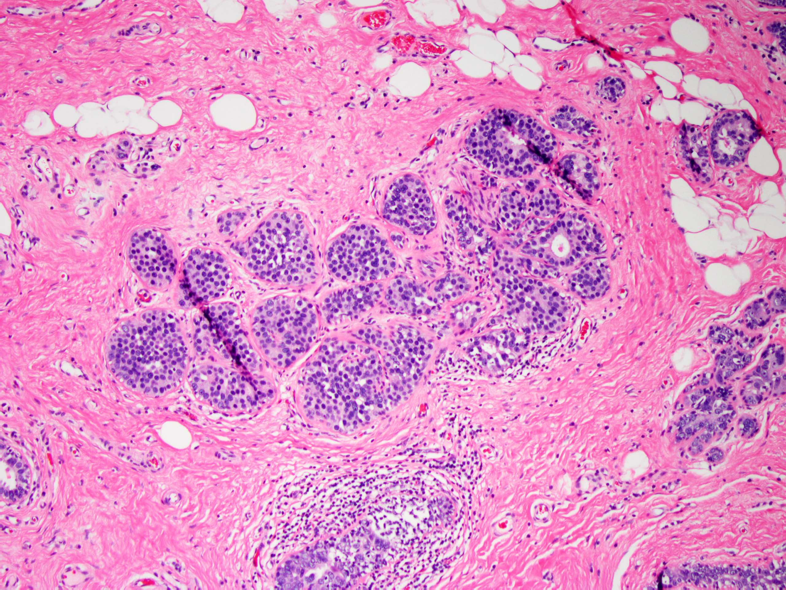 Ductal carcinoma in situ with lobular features