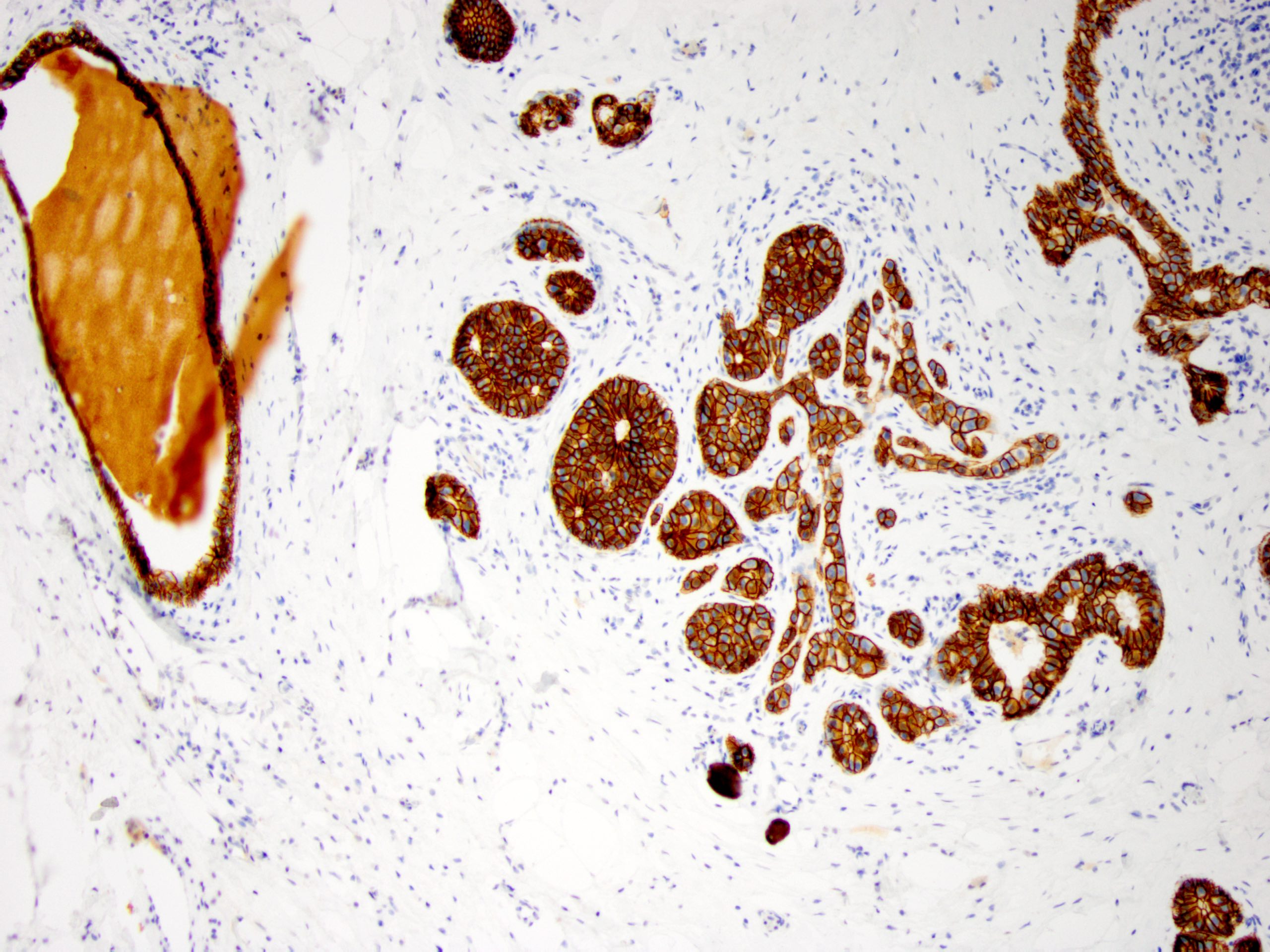 Ductal carcinoma in situ with lobular features