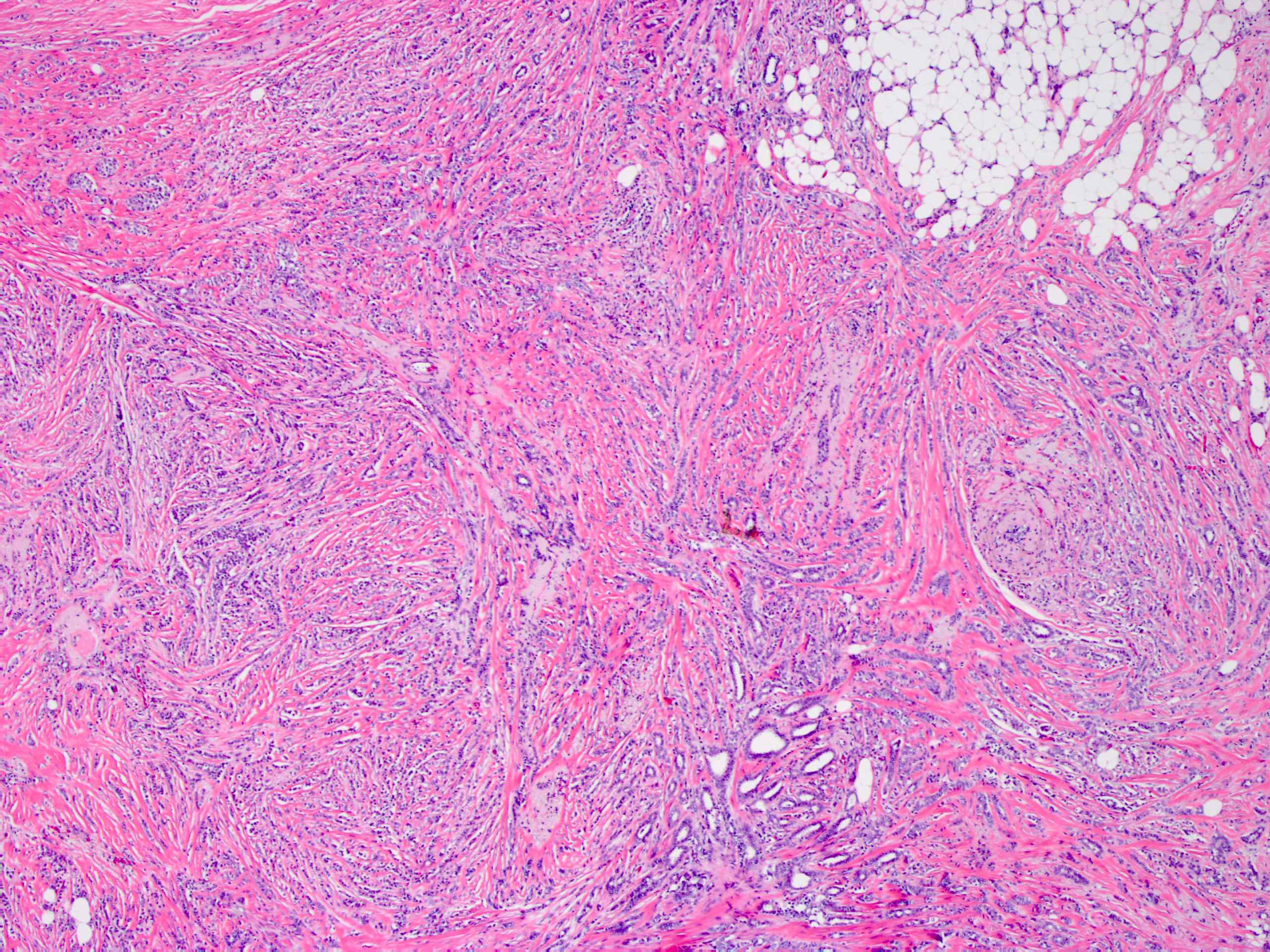Invasive lobular carcinoma of the breast