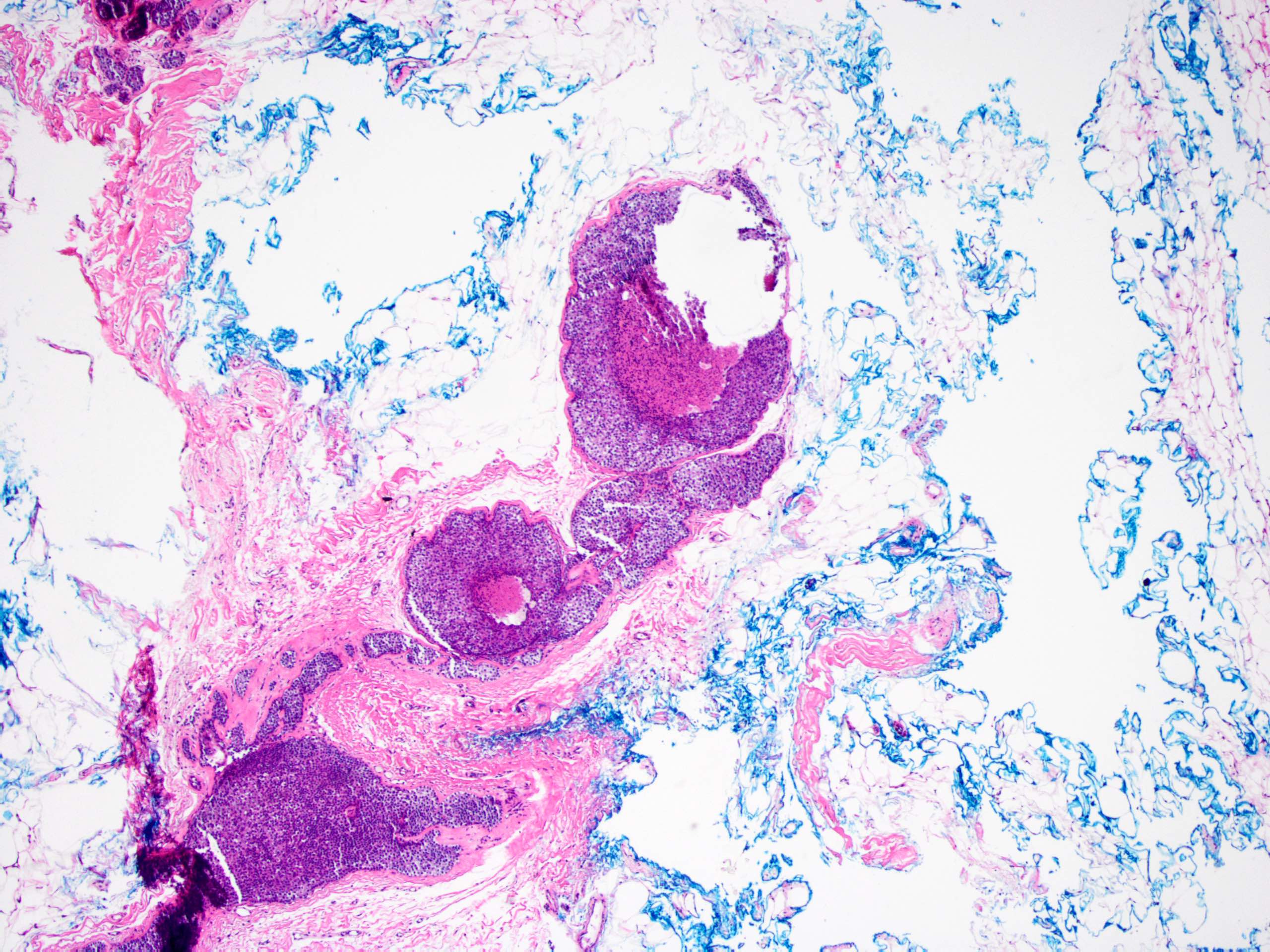 Lobular carcinoma in situ